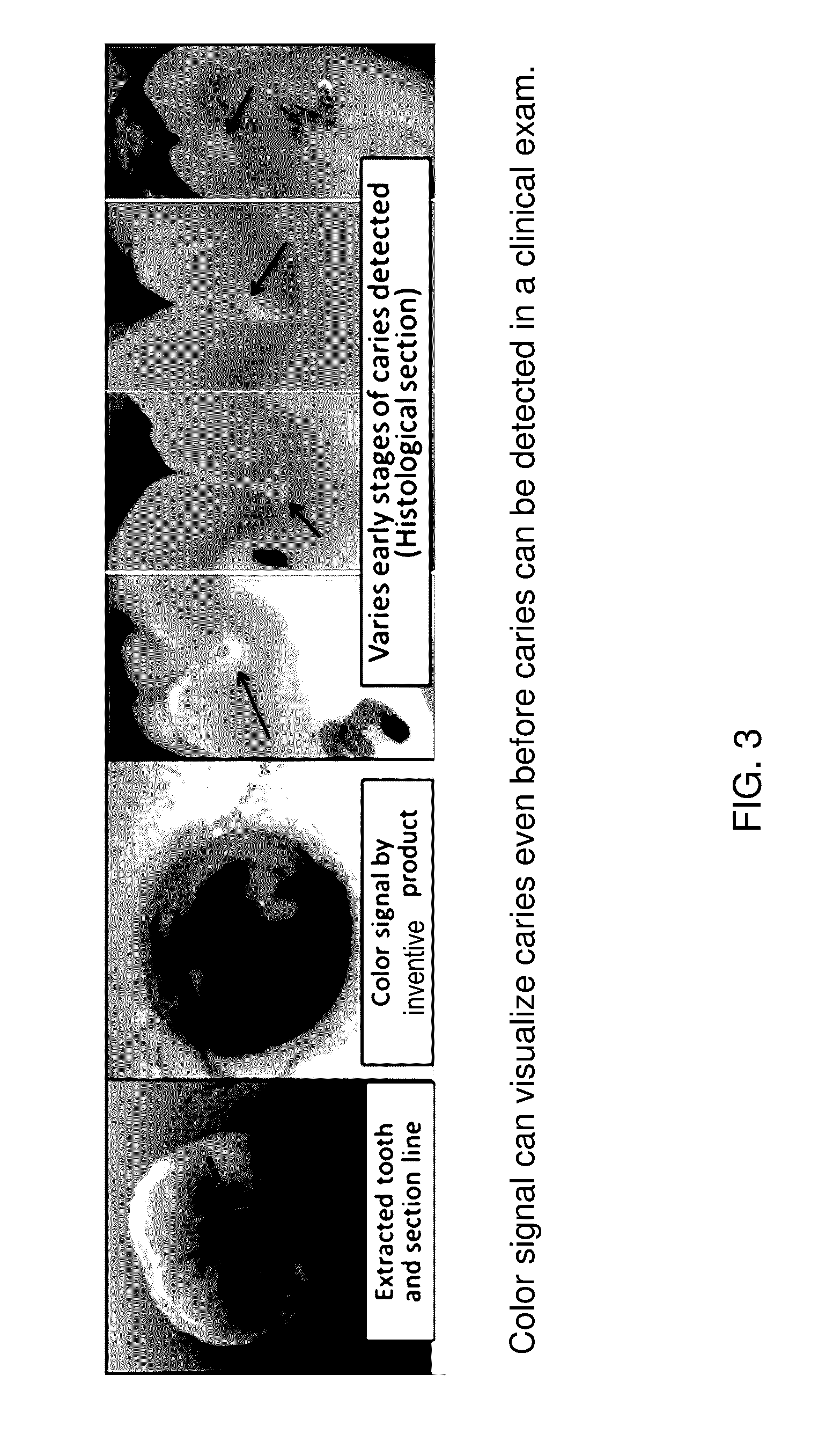 Methodology of dental caries detection