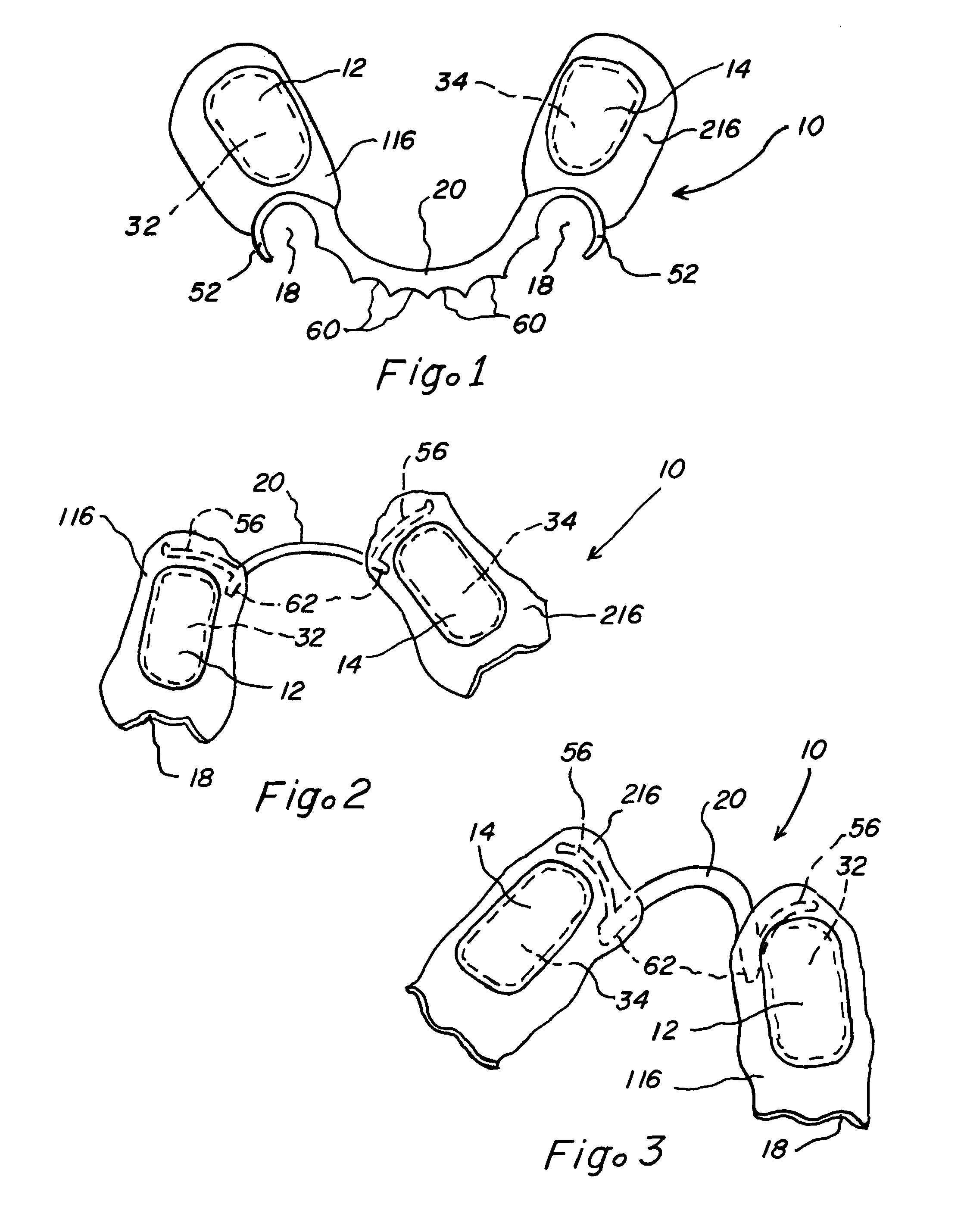 Oral appliances with major connectors and methods for manufacture