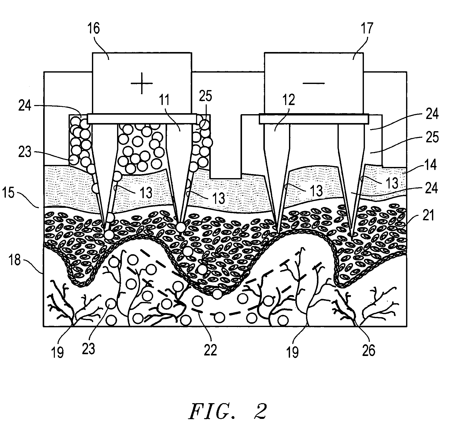 Transdermal delivery of therapeutic agent