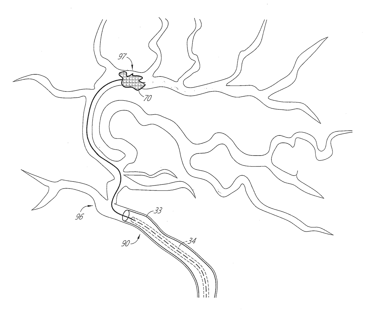 Method of pulsatile neurovascular aspiration with telescoping catheter