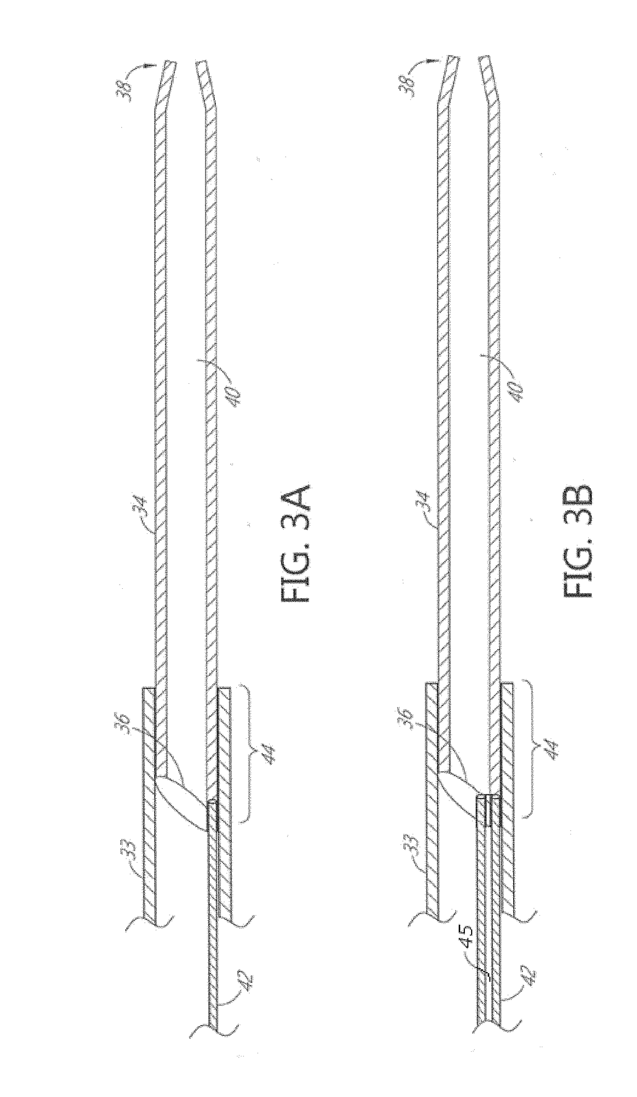 Method of pulsatile neurovascular aspiration with telescoping catheter