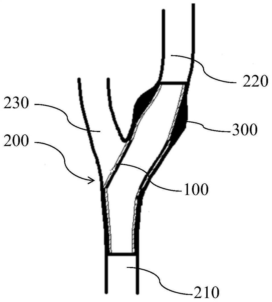 Stent