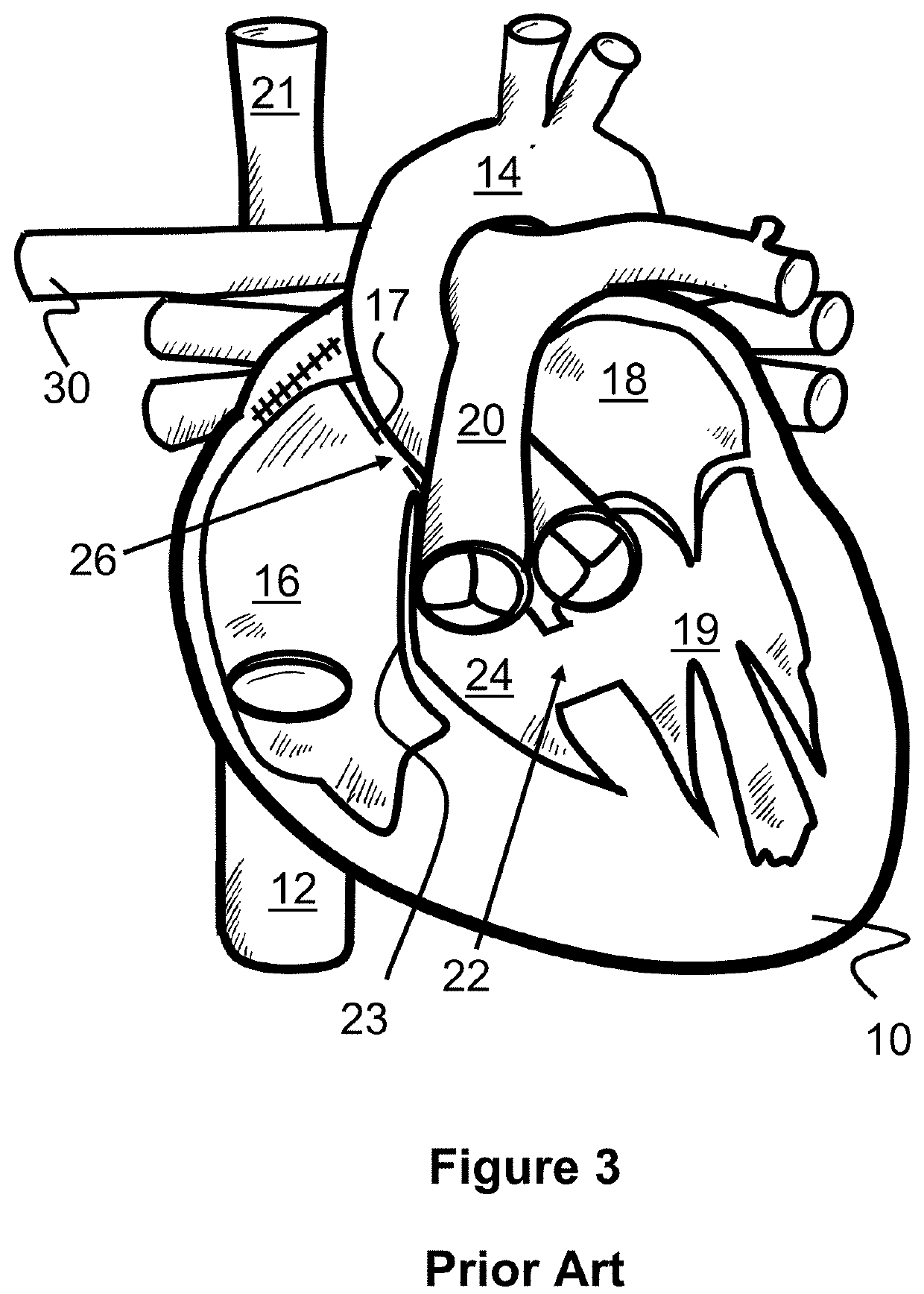 Method For Bypassing Defective Portions Of A Heart