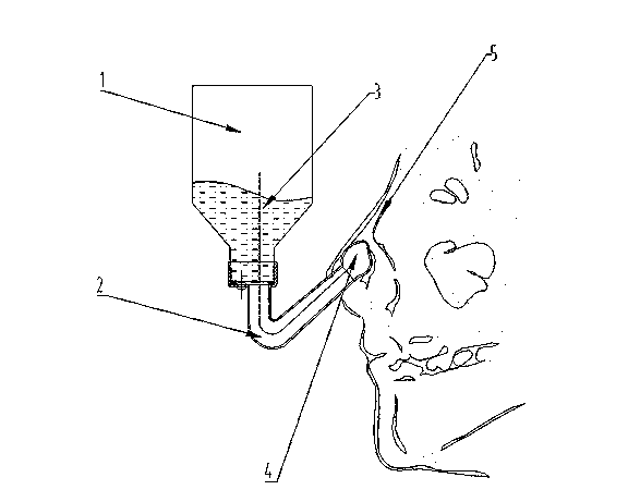 Nasal irrigator built in nasal vestibule