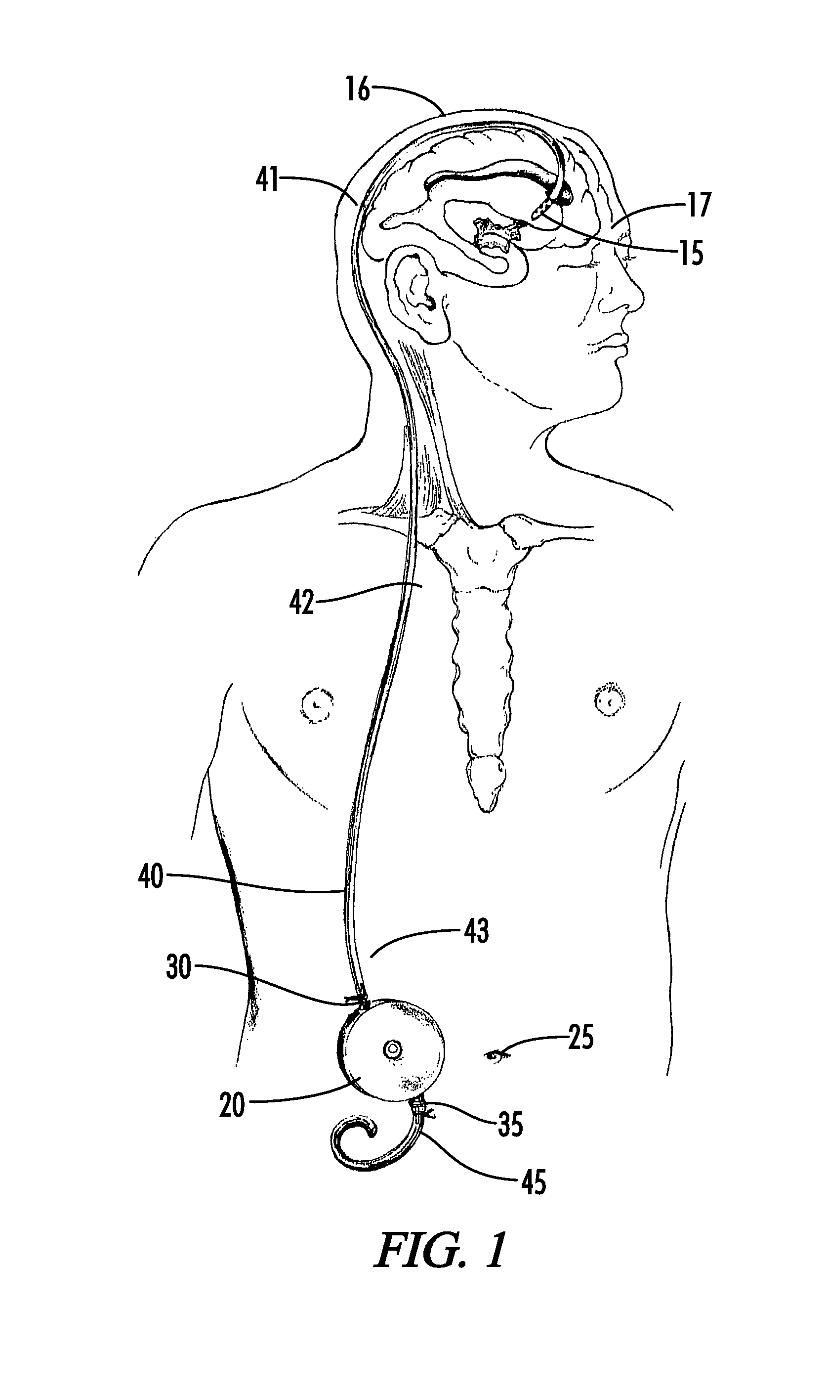 Implantable pump for removal of cerebrospinal fluid