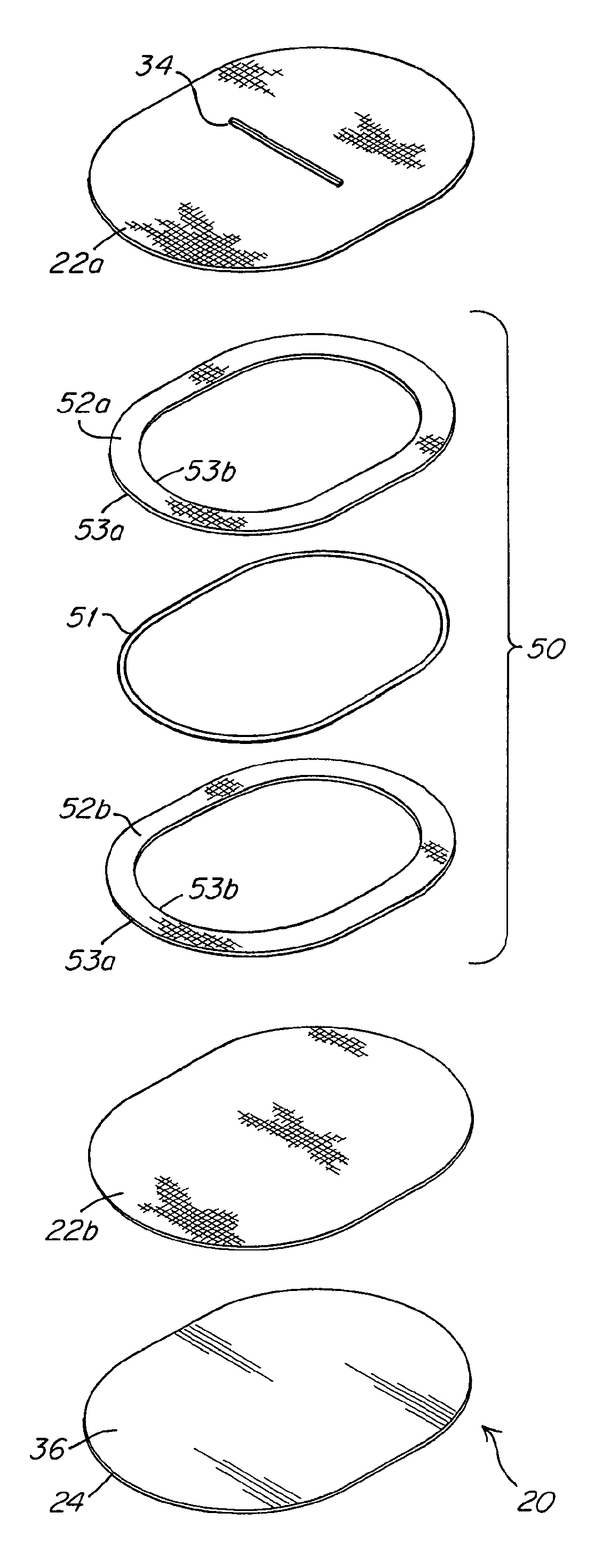 Implantable prosthesis