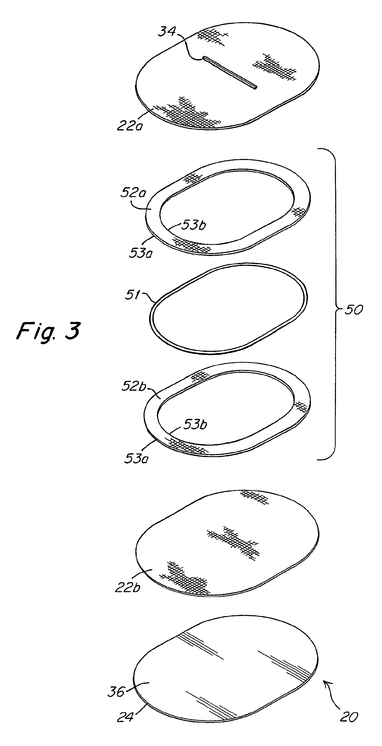 Implantable prosthesis