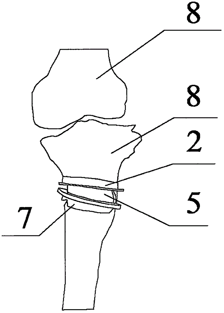 Navigation device capable of accurately positioning high tibial osteotomy, and manufacturing method of navigation device