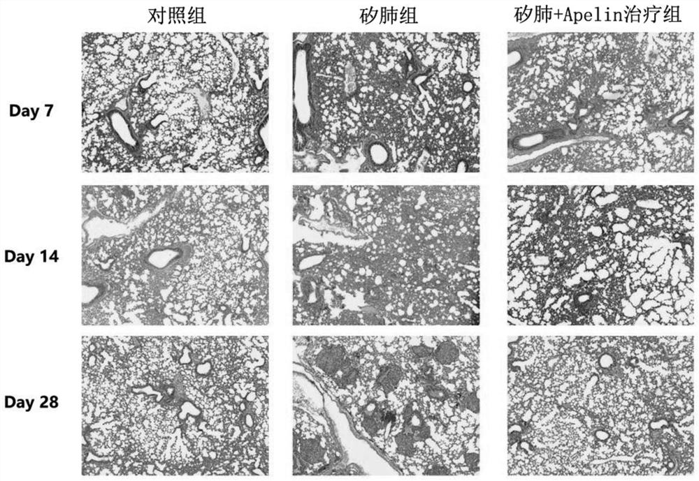 Application of Apelin in preparation of medicine for treating silicosis