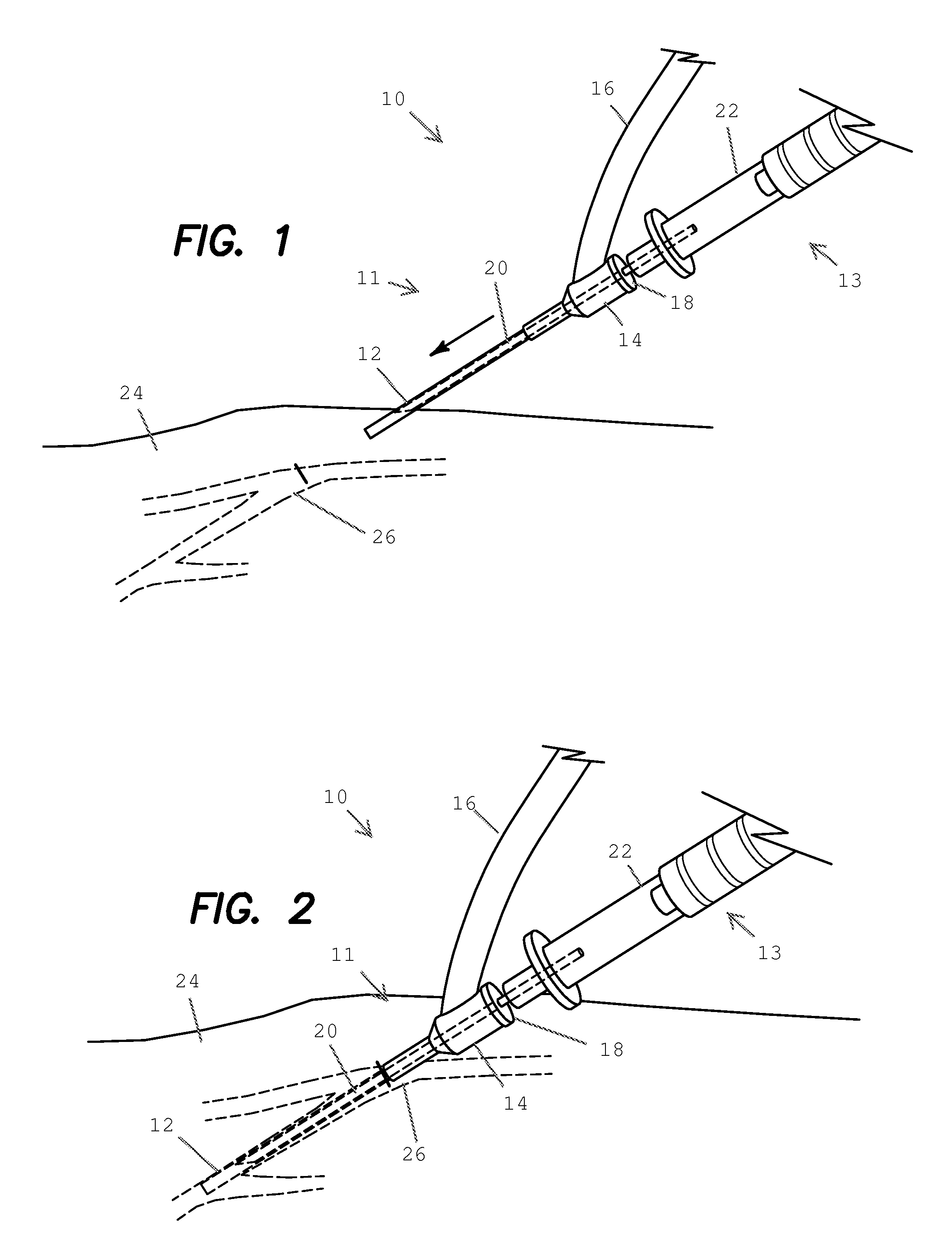 Angiocatheter and method of operating the same