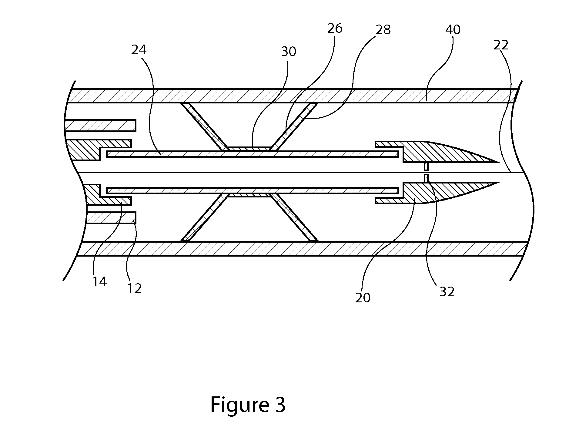 Implantable occluder or filter