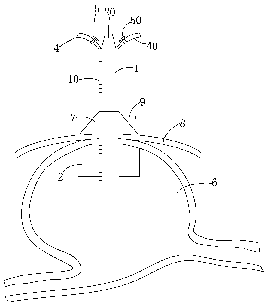 Gastrostomy catheter cleaning kit