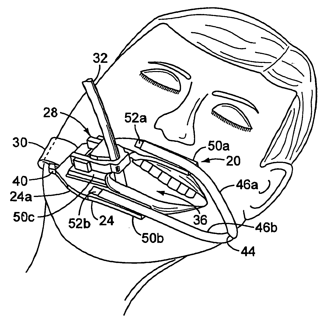 Endotracheal Tube Holder