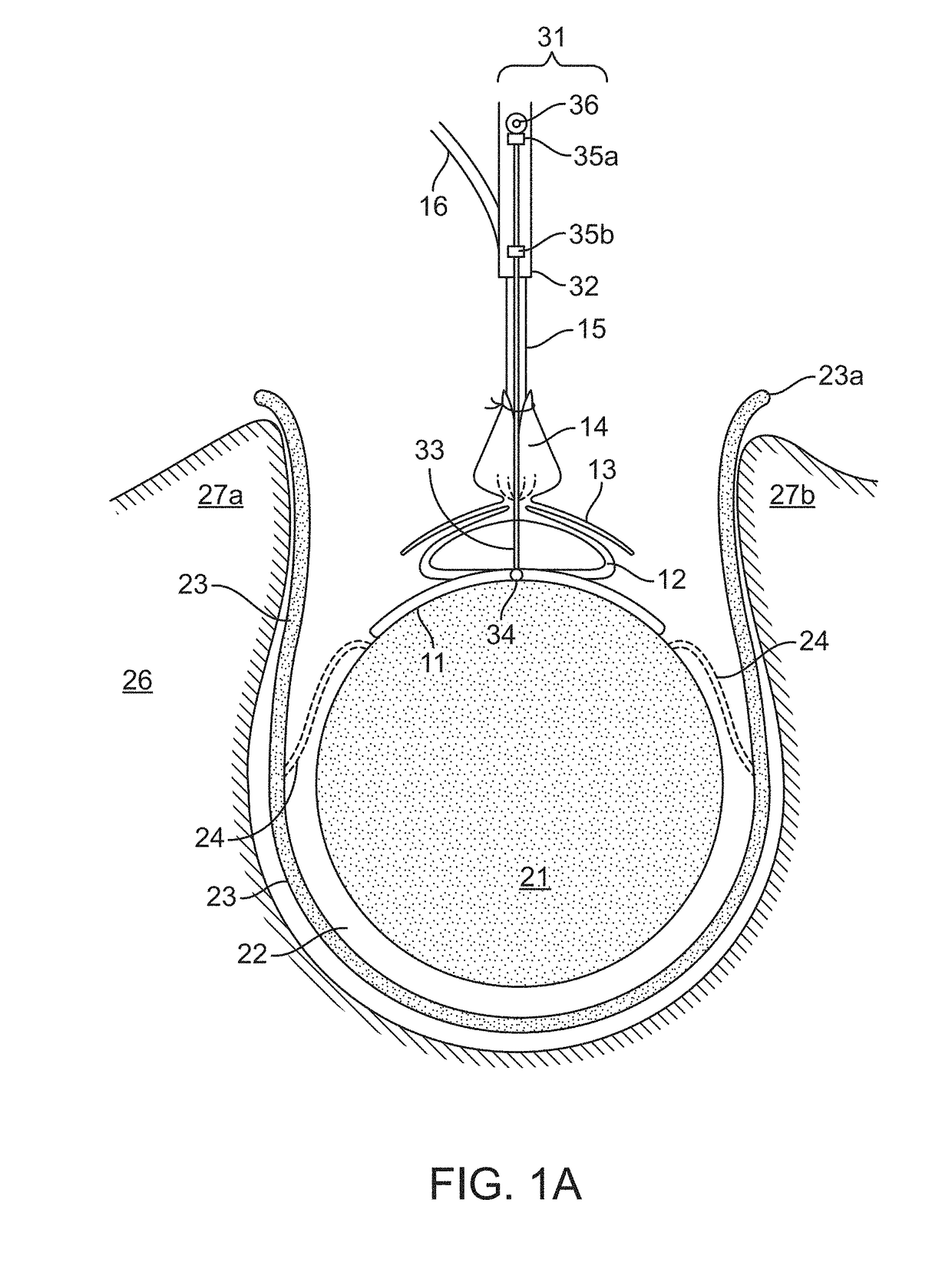 High frequency stimulation of the spinal cord from inside the dura