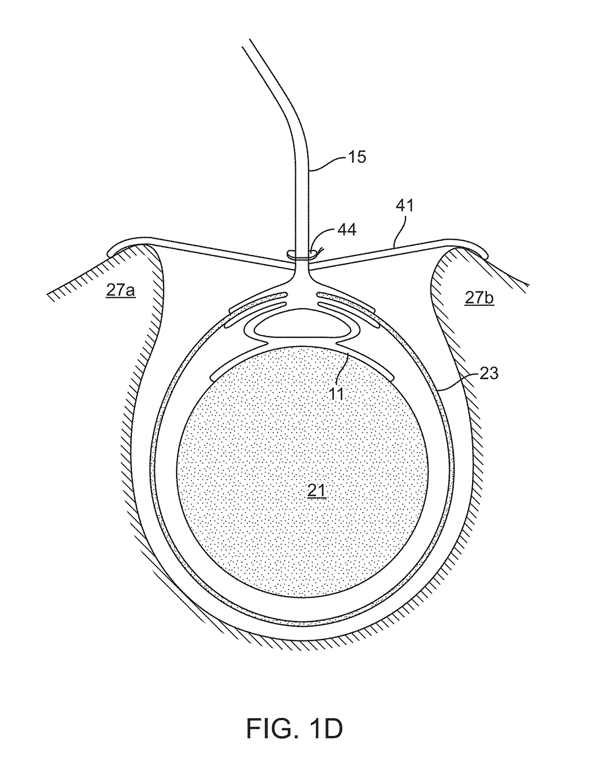 High frequency stimulation of the spinal cord from inside the dura