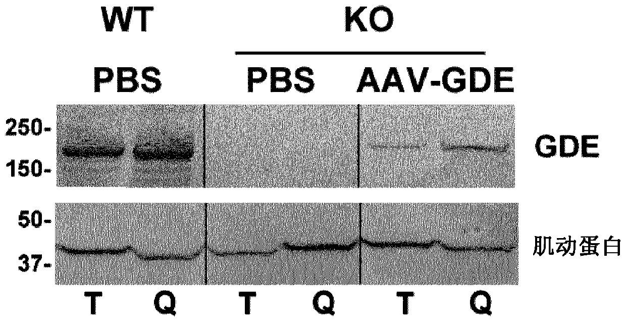 Treatment of glycogen storage disease iii