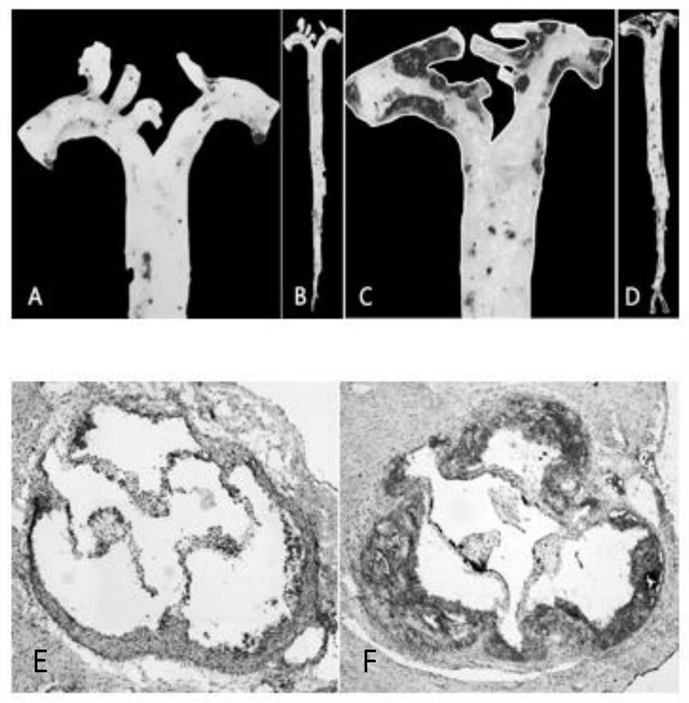 Application of a long non-coding RNA and its interfering RNA in the treatment of atherosclerosis