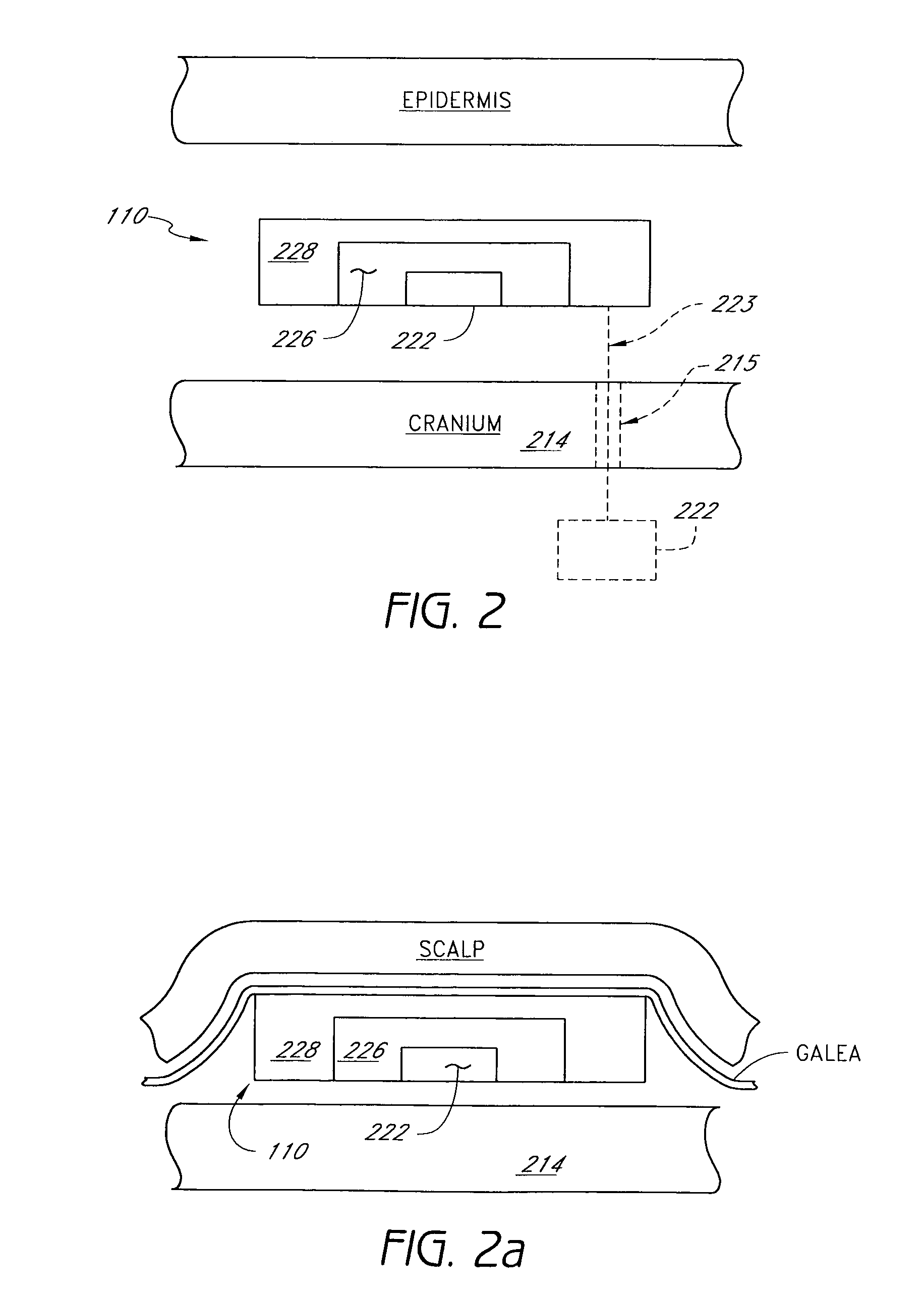 Implantable seizure monitor