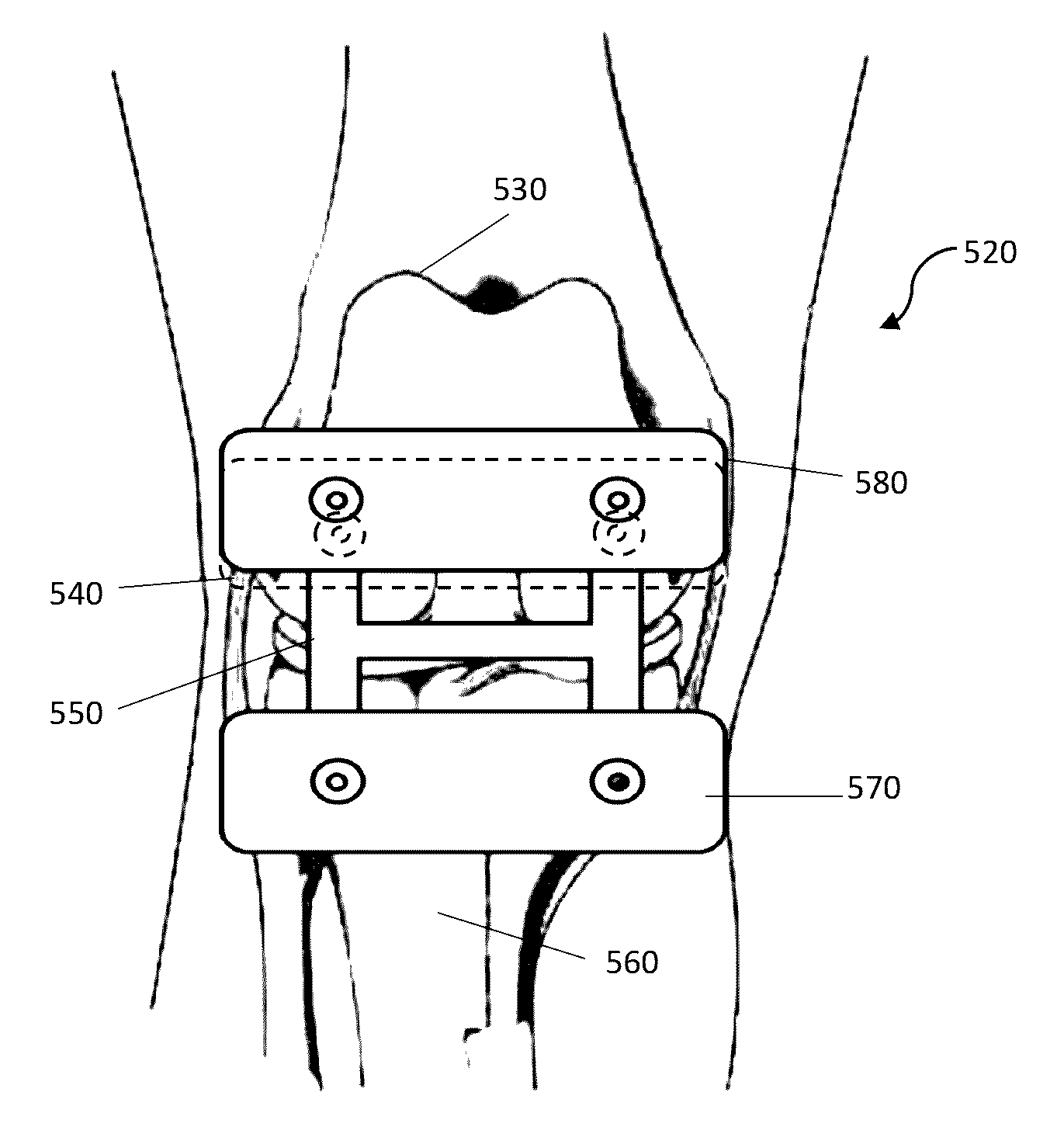 Combined measured resection methods and instruments for knee arthroplasty