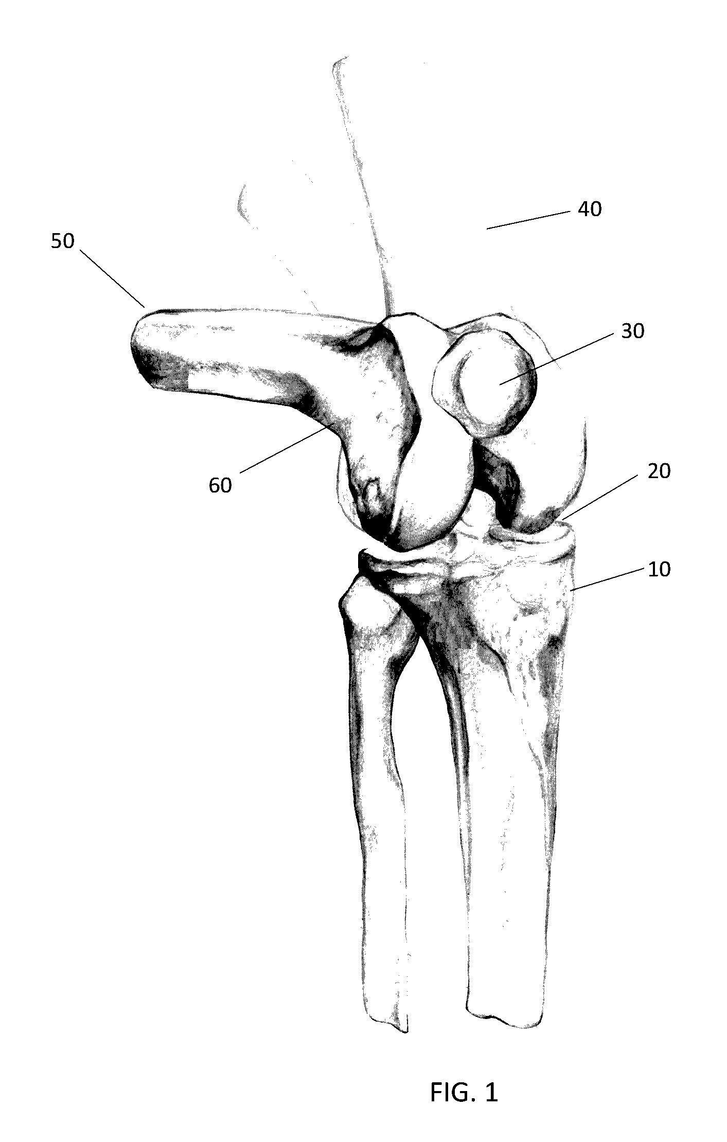 Combined measured resection methods and instruments for knee arthroplasty