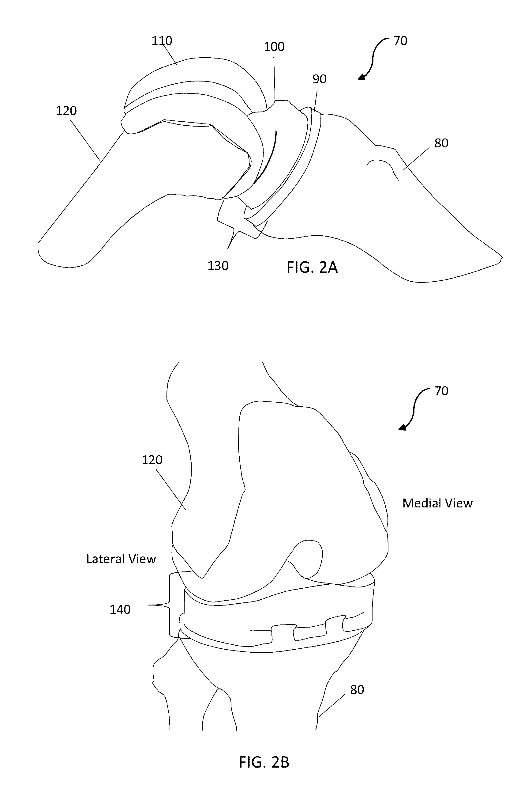 Combined measured resection methods and instruments for knee arthroplasty