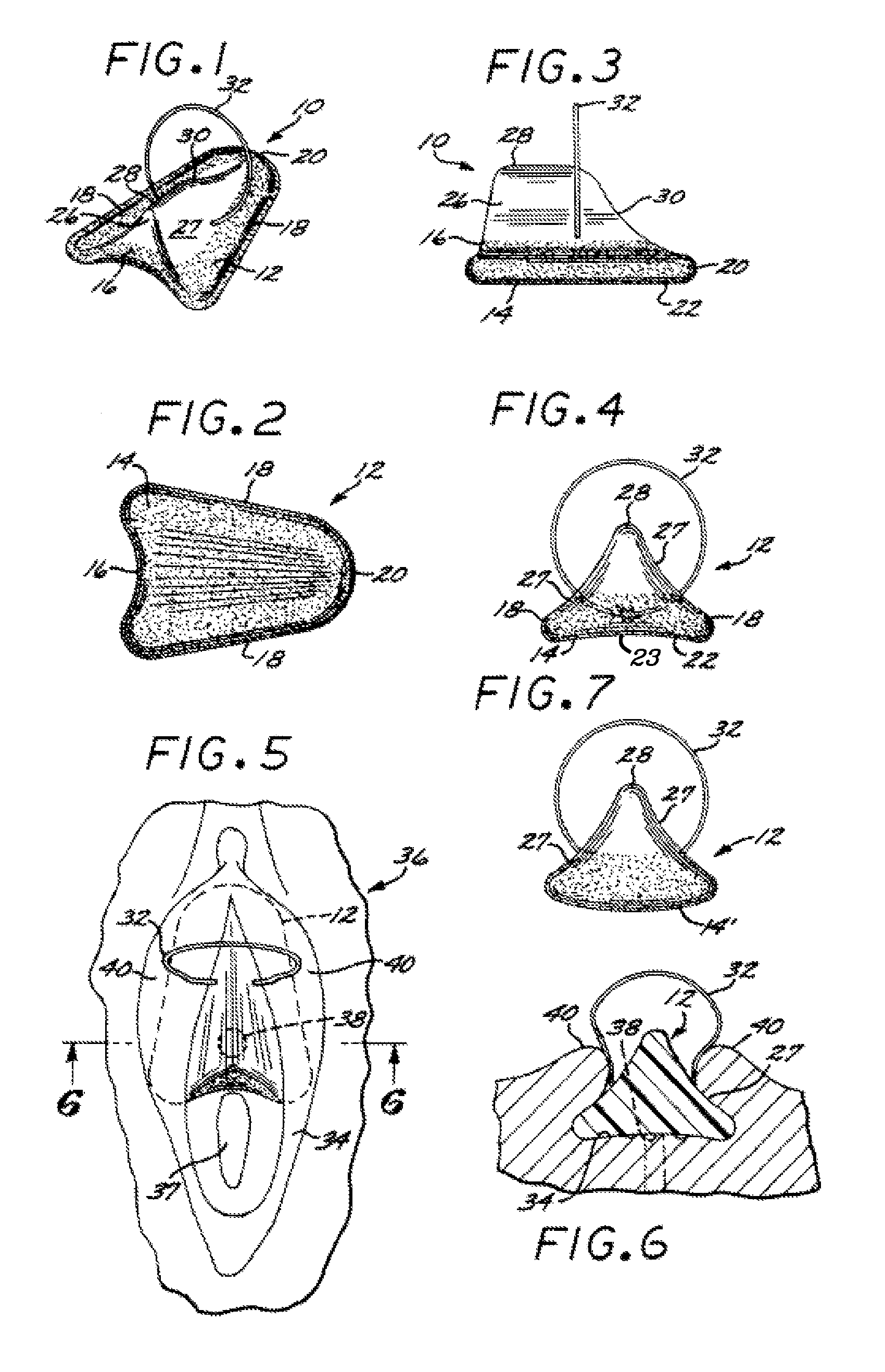 Systems and methods for incontinence control