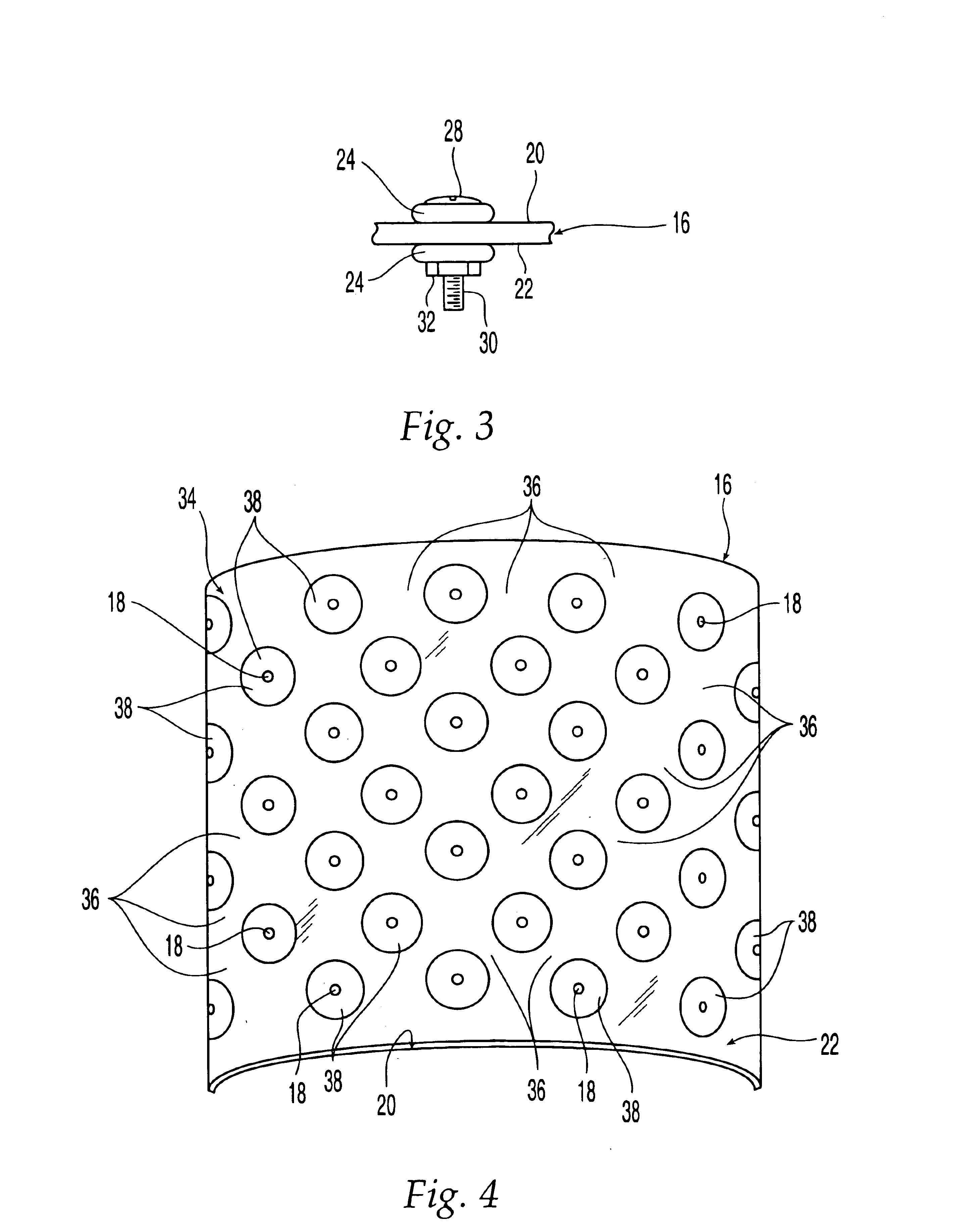 Demineralized bone-derived implants