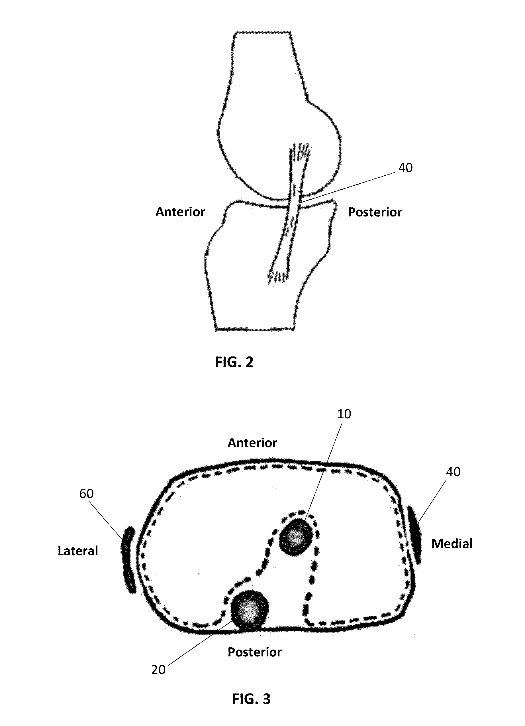 Patient specific soft tissue protectors and retractors