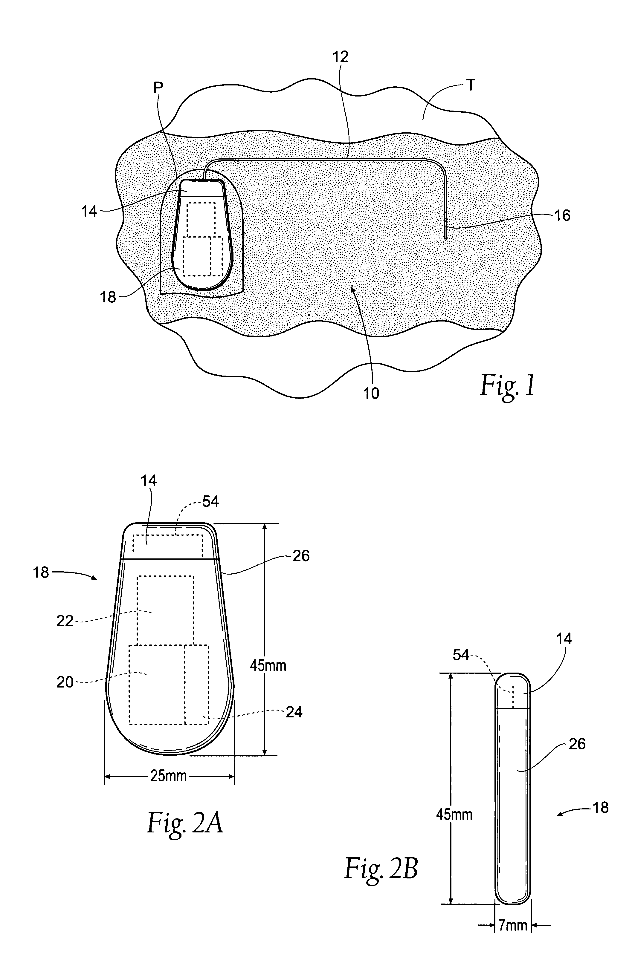 Implantable pulse generator power management