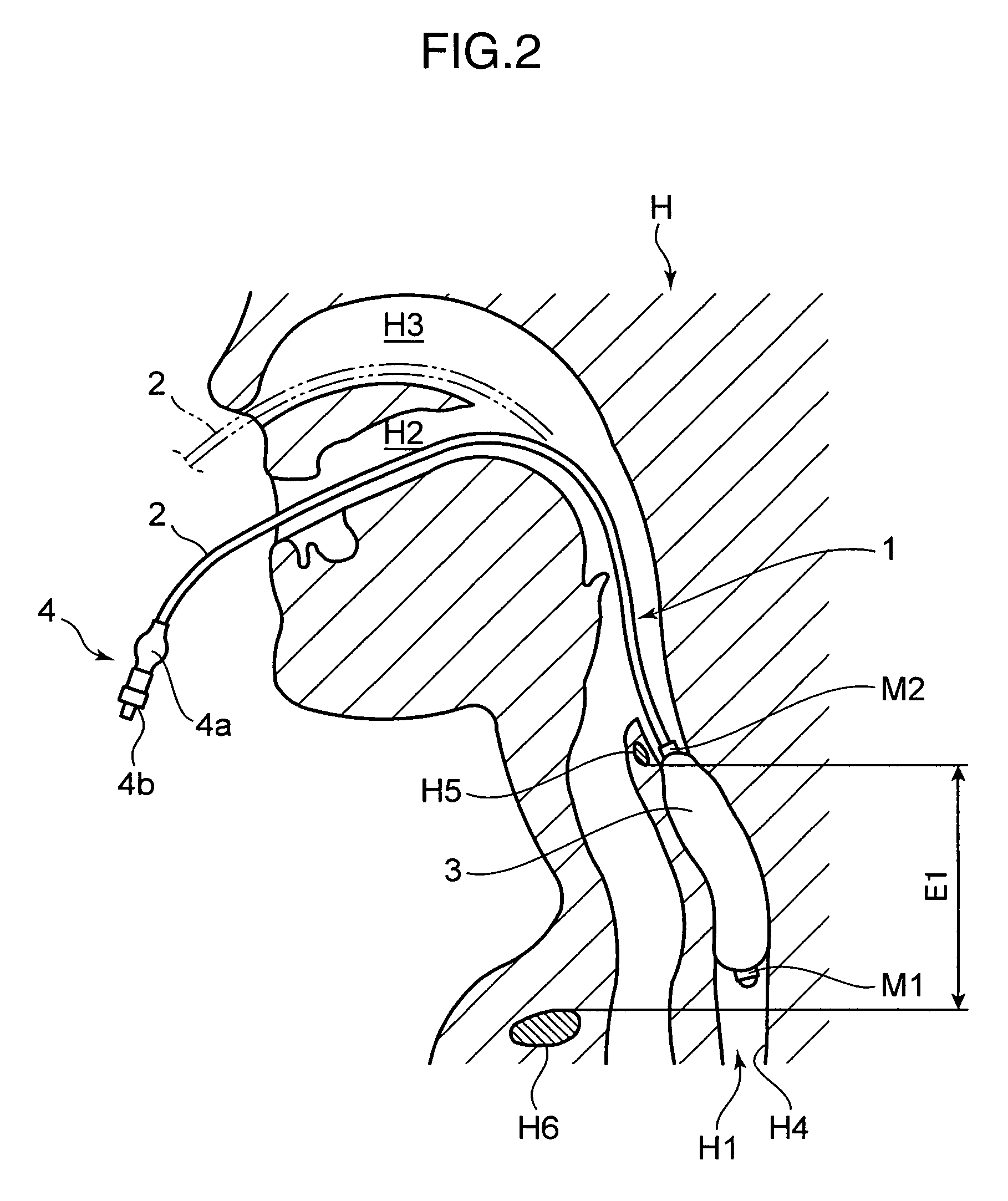 Brain cooling device and brain cooling system comprising the device