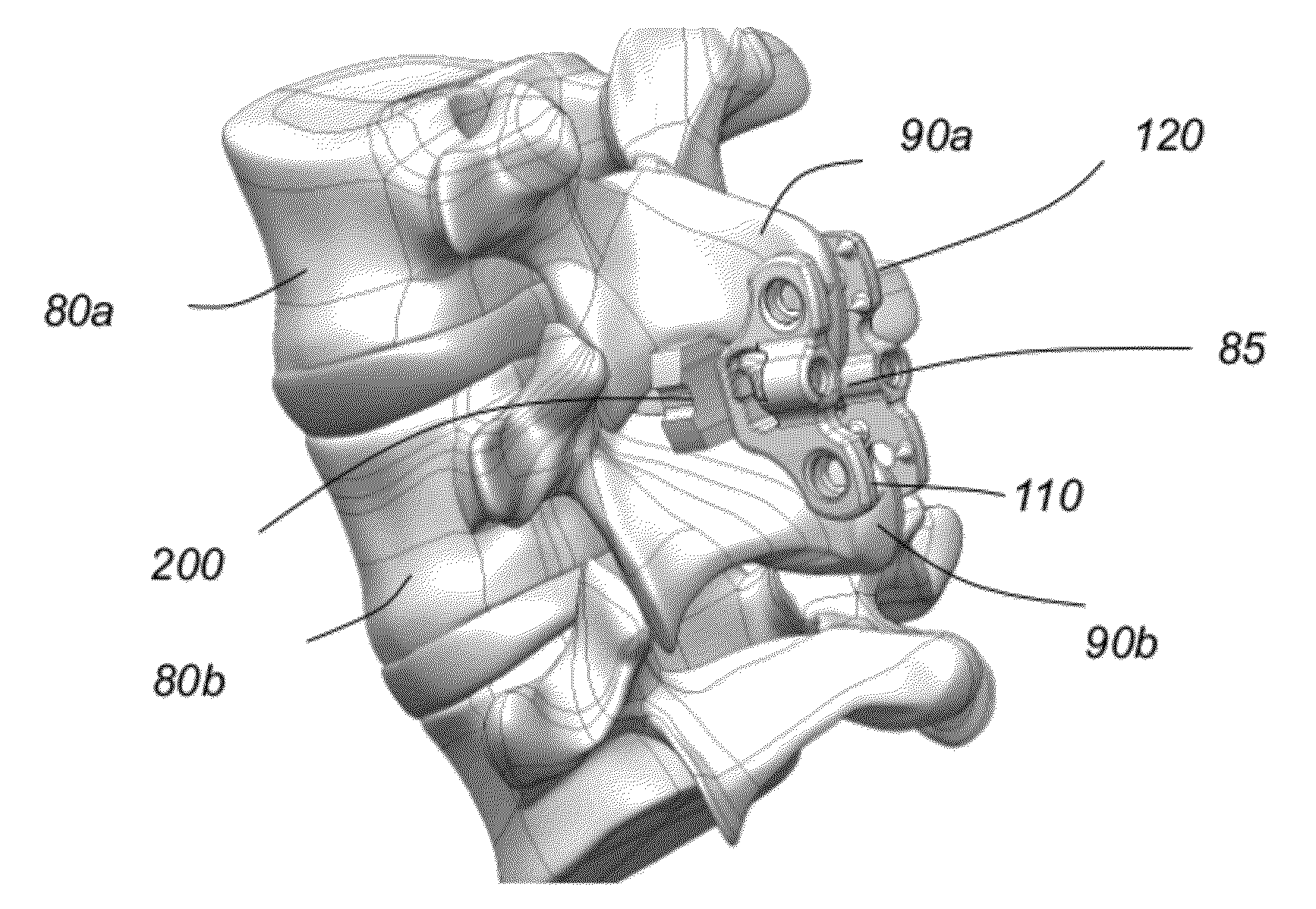 Interspinous spacer implant