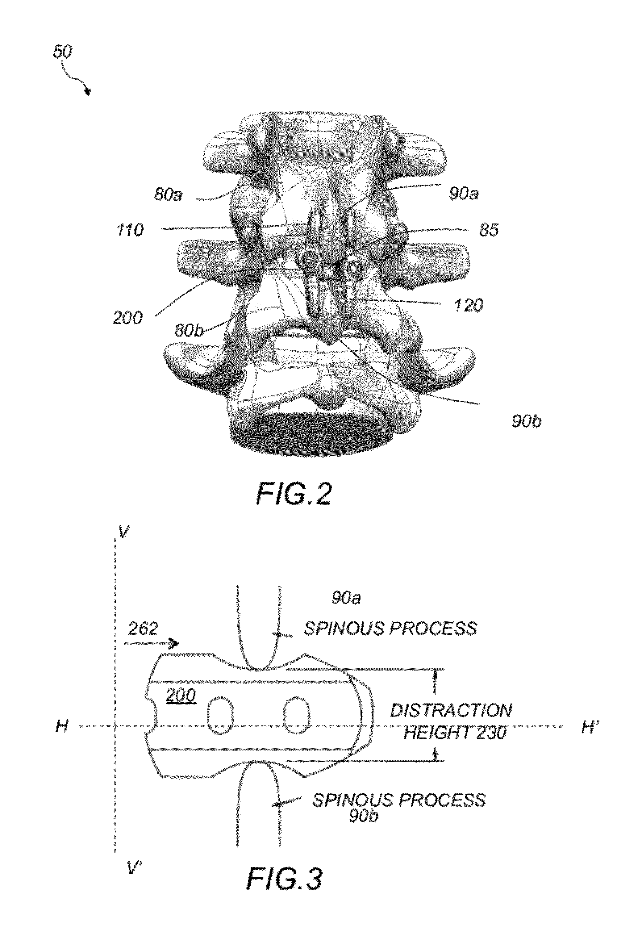 Interspinous spacer implant