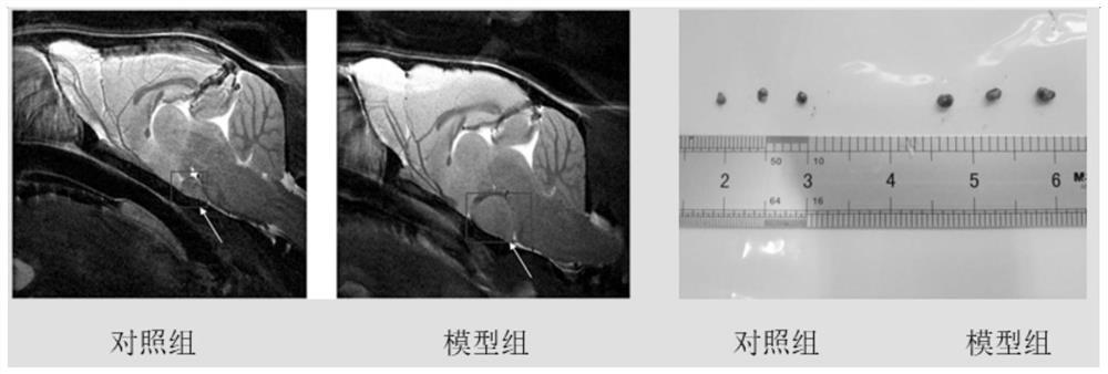 Application of inhibitor of nlrp3 inflammasome in preparation of medicine for treating pituitary adenoma and medicine for treating pituitary adenoma