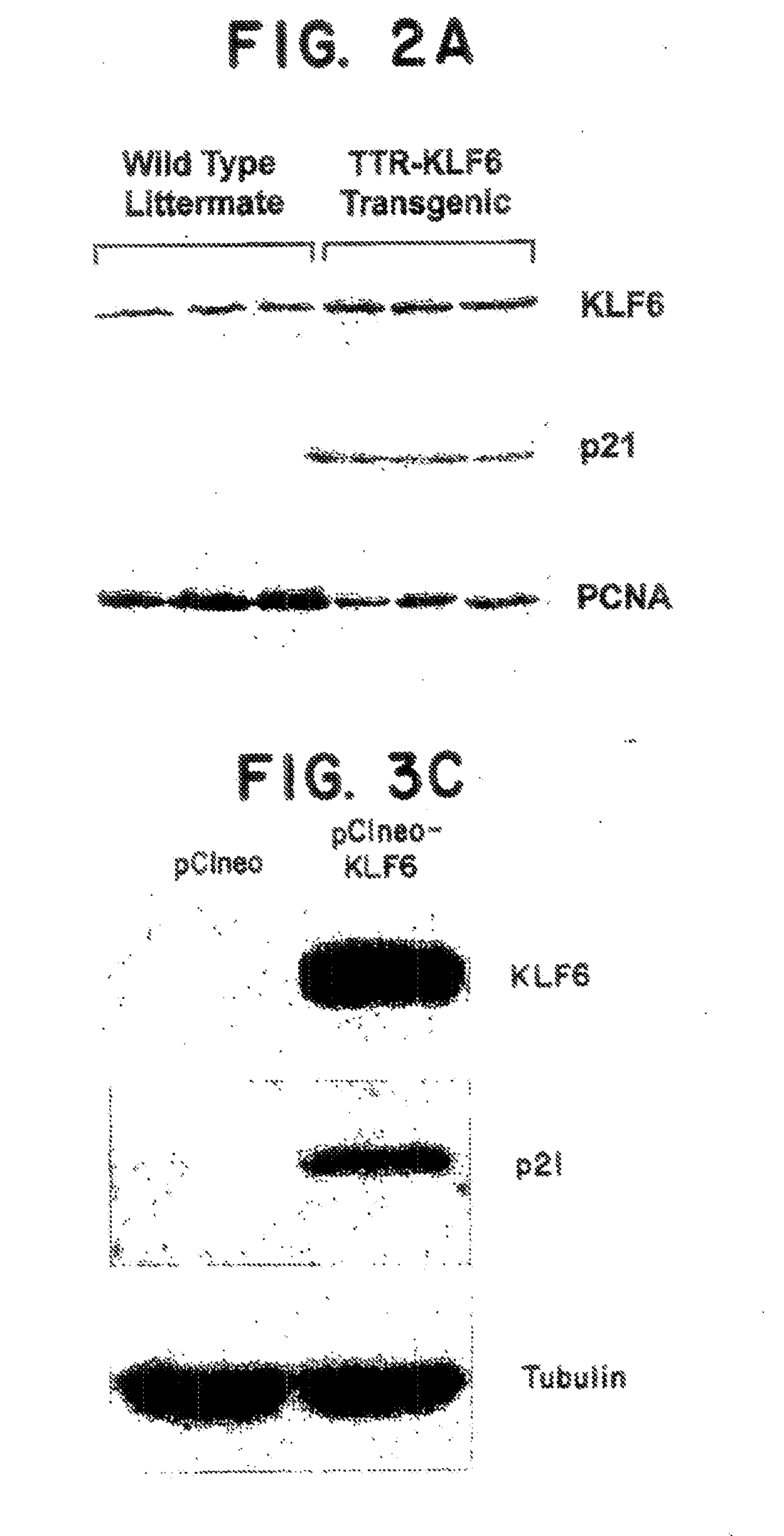 Kruppel-like factor 6 (KLF6), a tumor suppressor protein, and diagnostics, therapeutics, and screening based on this protein