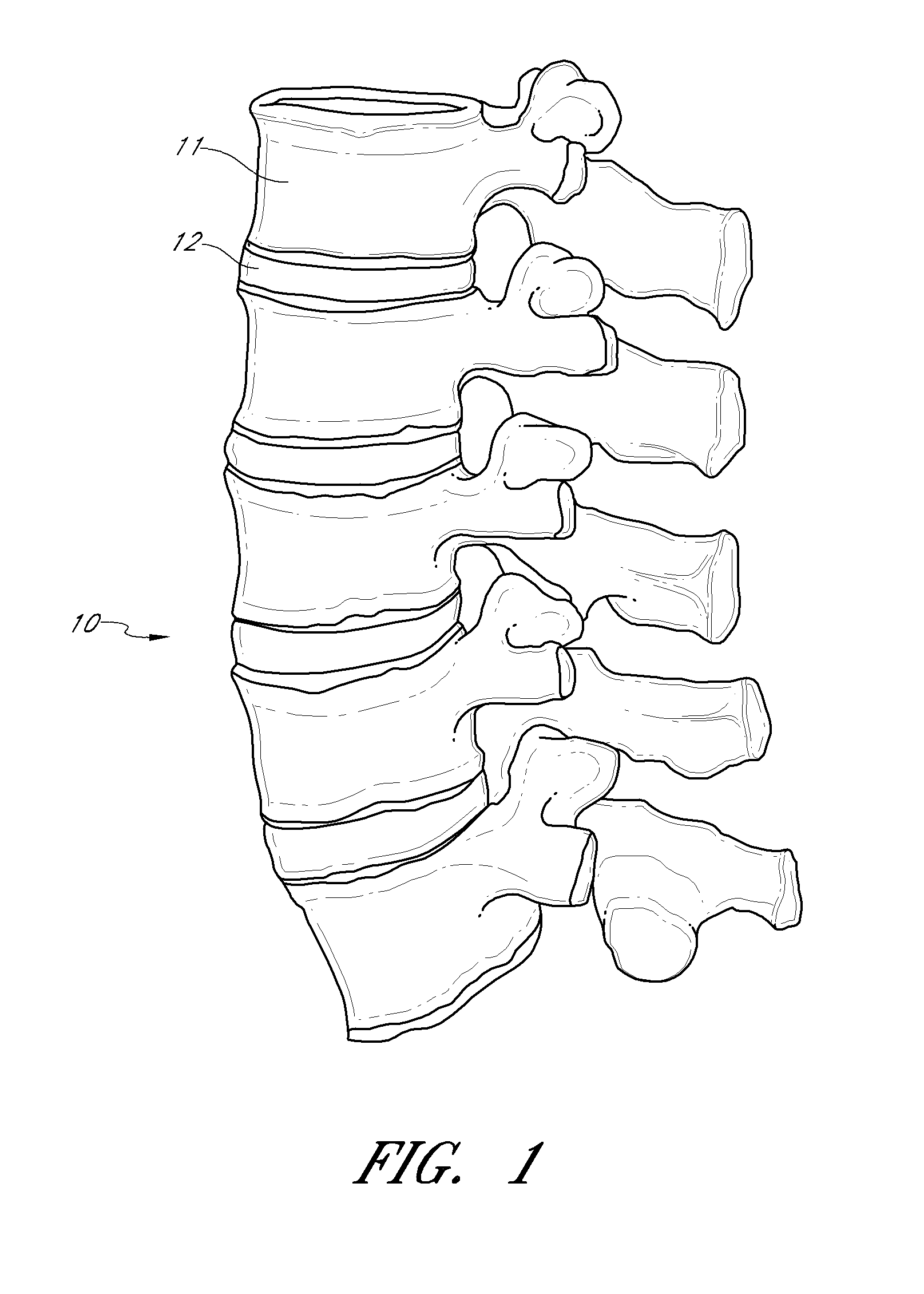 Method and apparatus for minimally invasive insertion of intervertebral implants