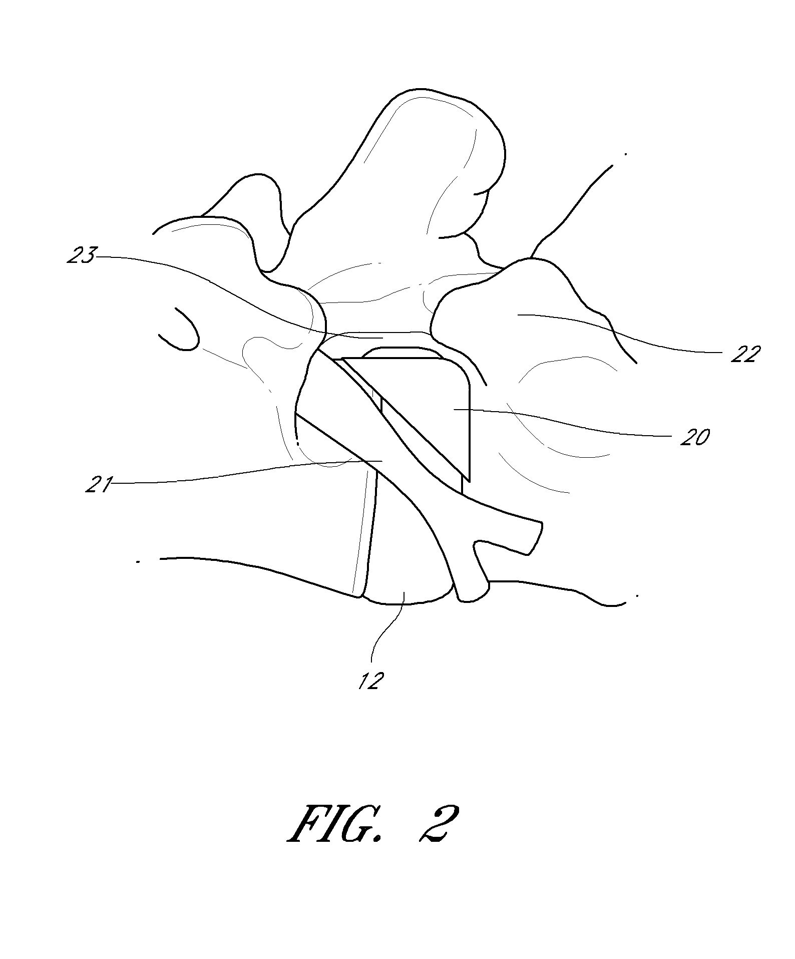 Method and apparatus for minimally invasive insertion of intervertebral implants