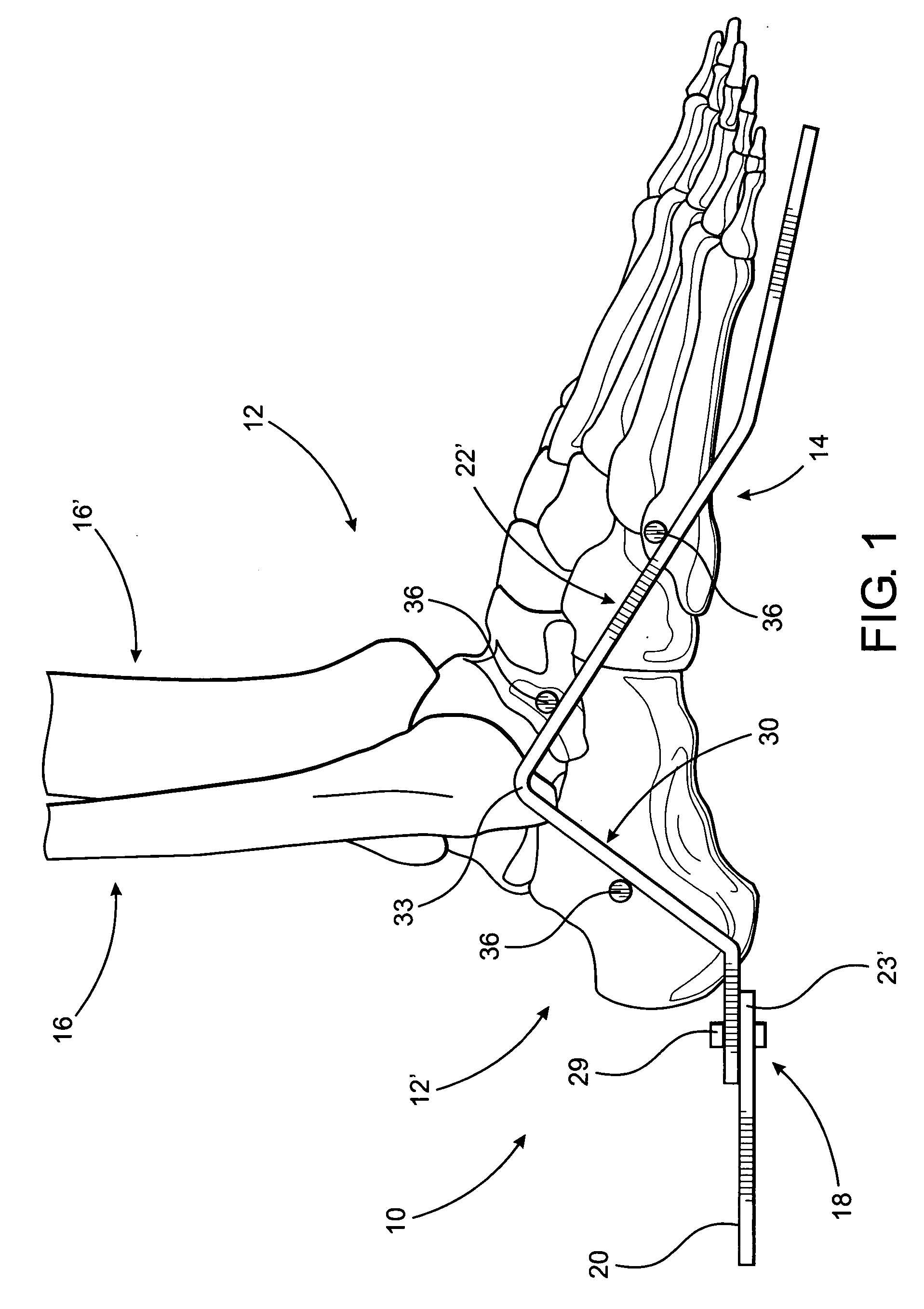 External fixator assembly