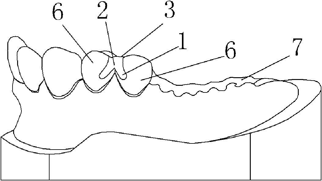 Combined short arm clasp for removable partial denture