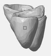 A method for automatic orientation optimization of dental crown models based on 3D printing