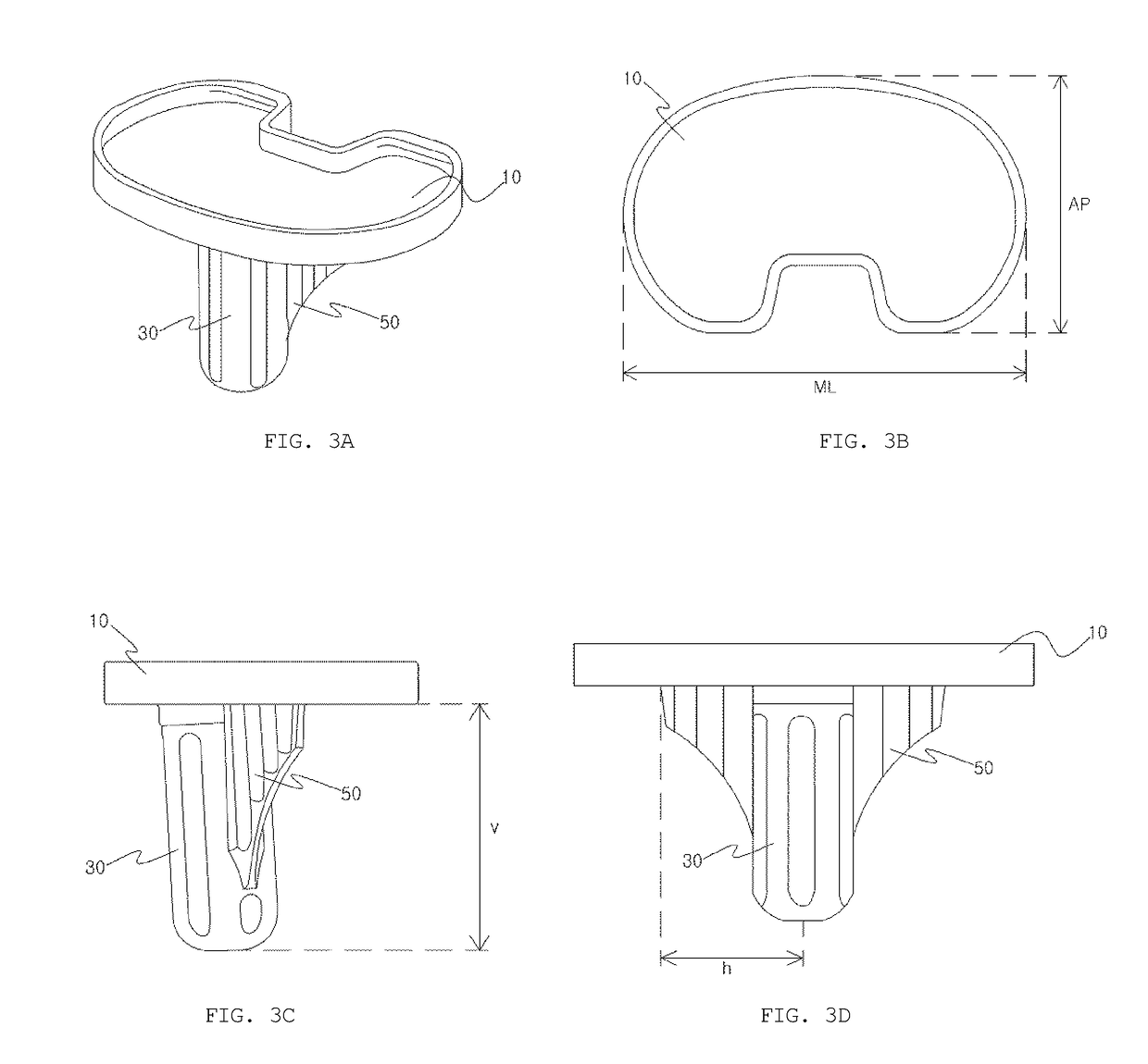 Method of manufacturing patient-customized tibial element