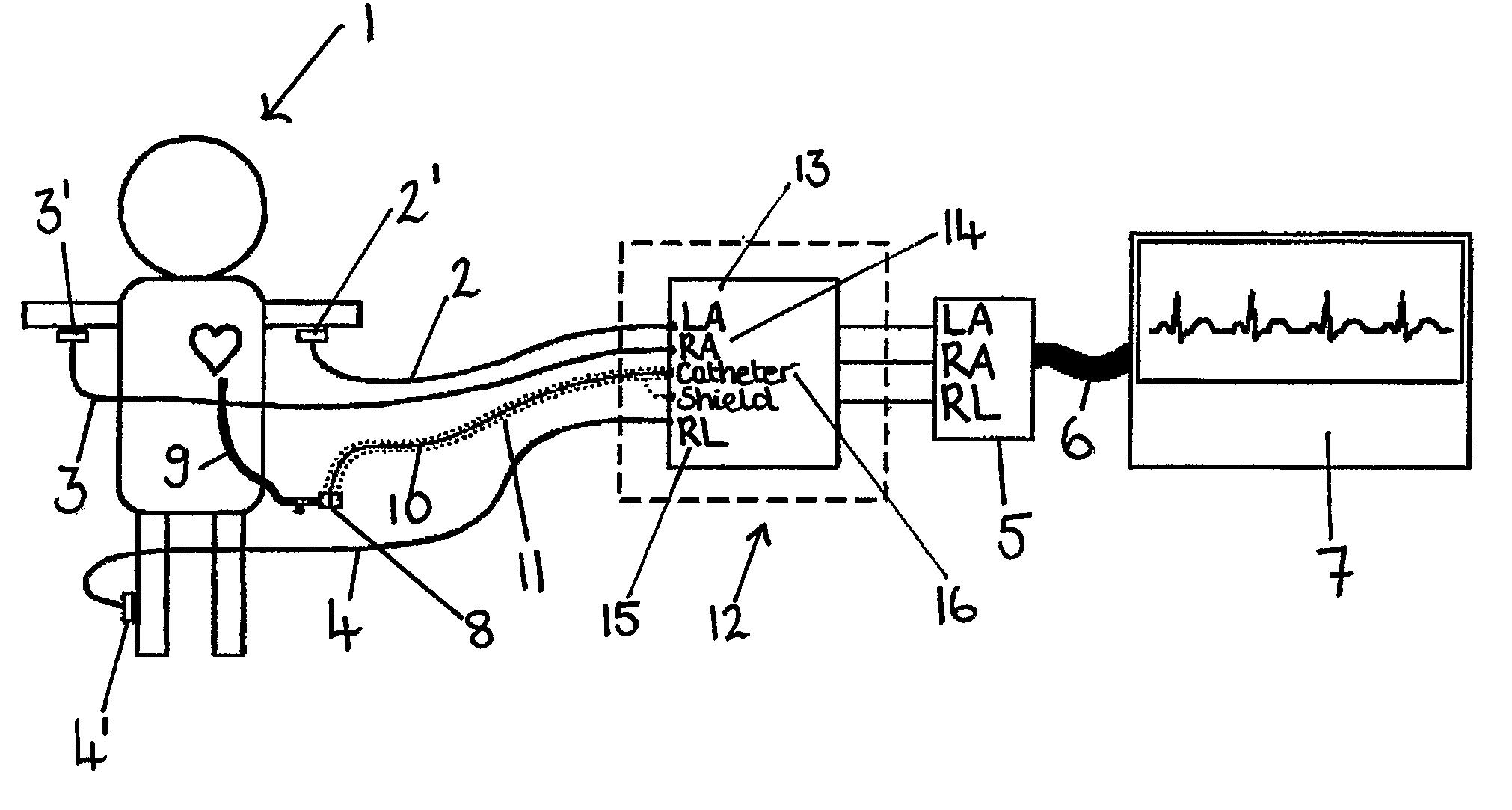 Apparatus for detecting the position of a percutaneously-inserted intravenous catheter