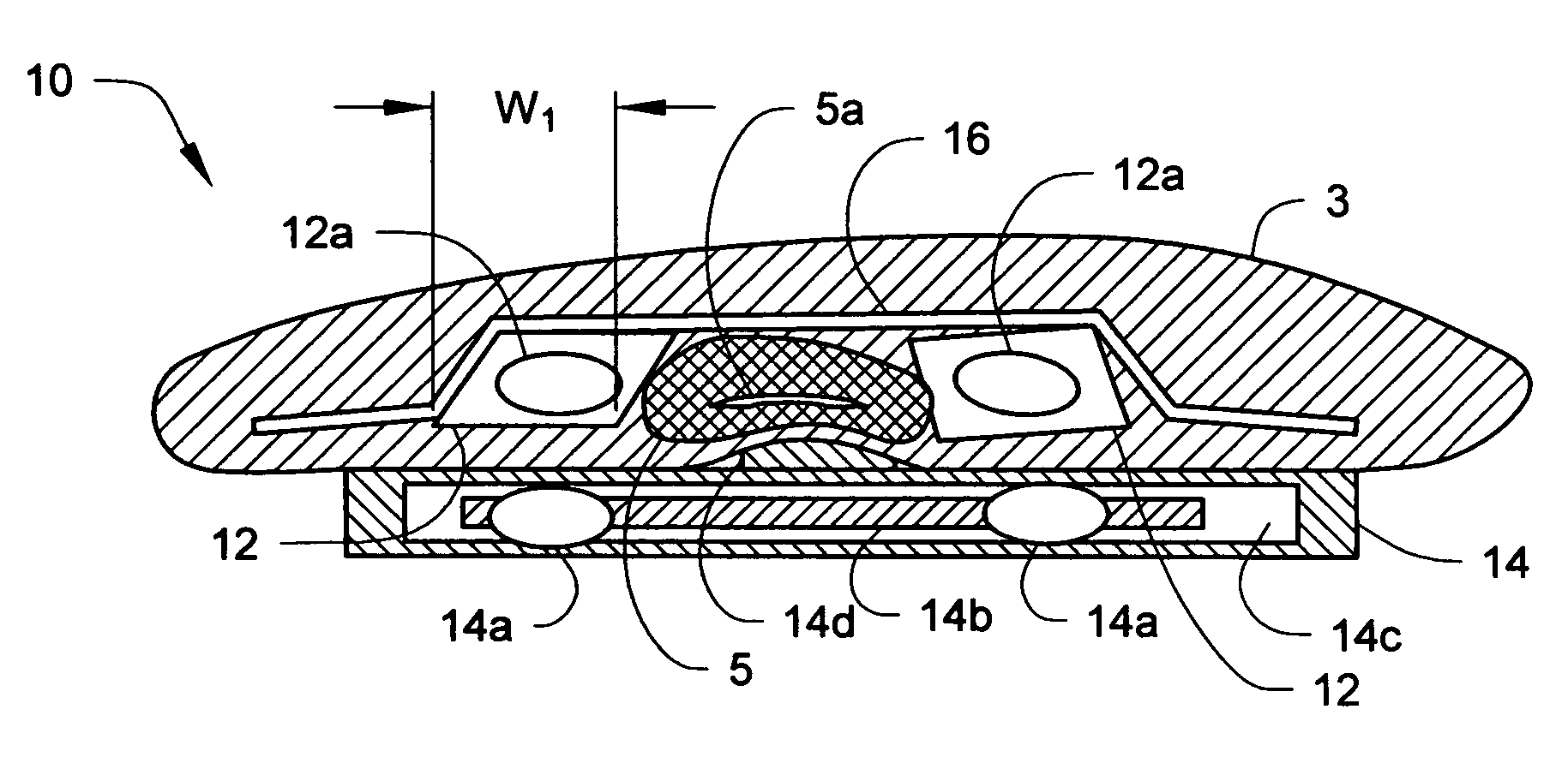 Urethral occlusive assembly for preventing urinary incontinence