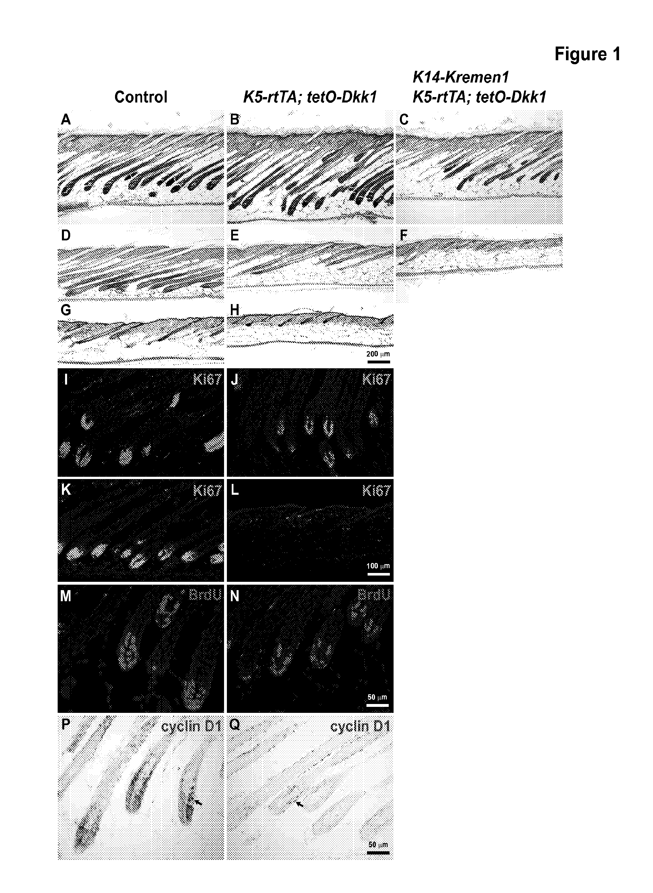 Inhibition of hair follicle growth by the wnt inhibitor dkk1