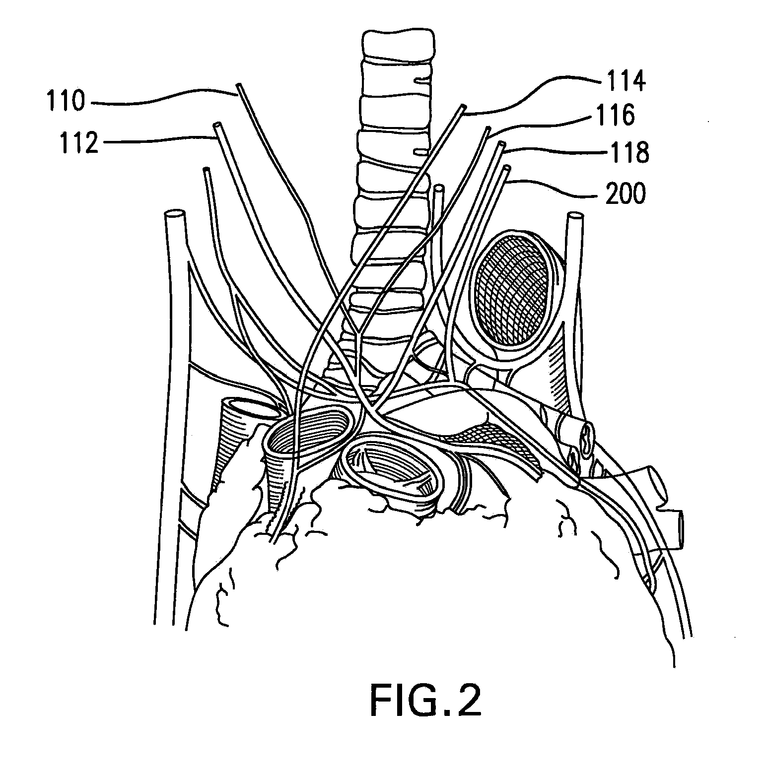 Method and System for Treating Acute Heart Failure by Neuromodulation