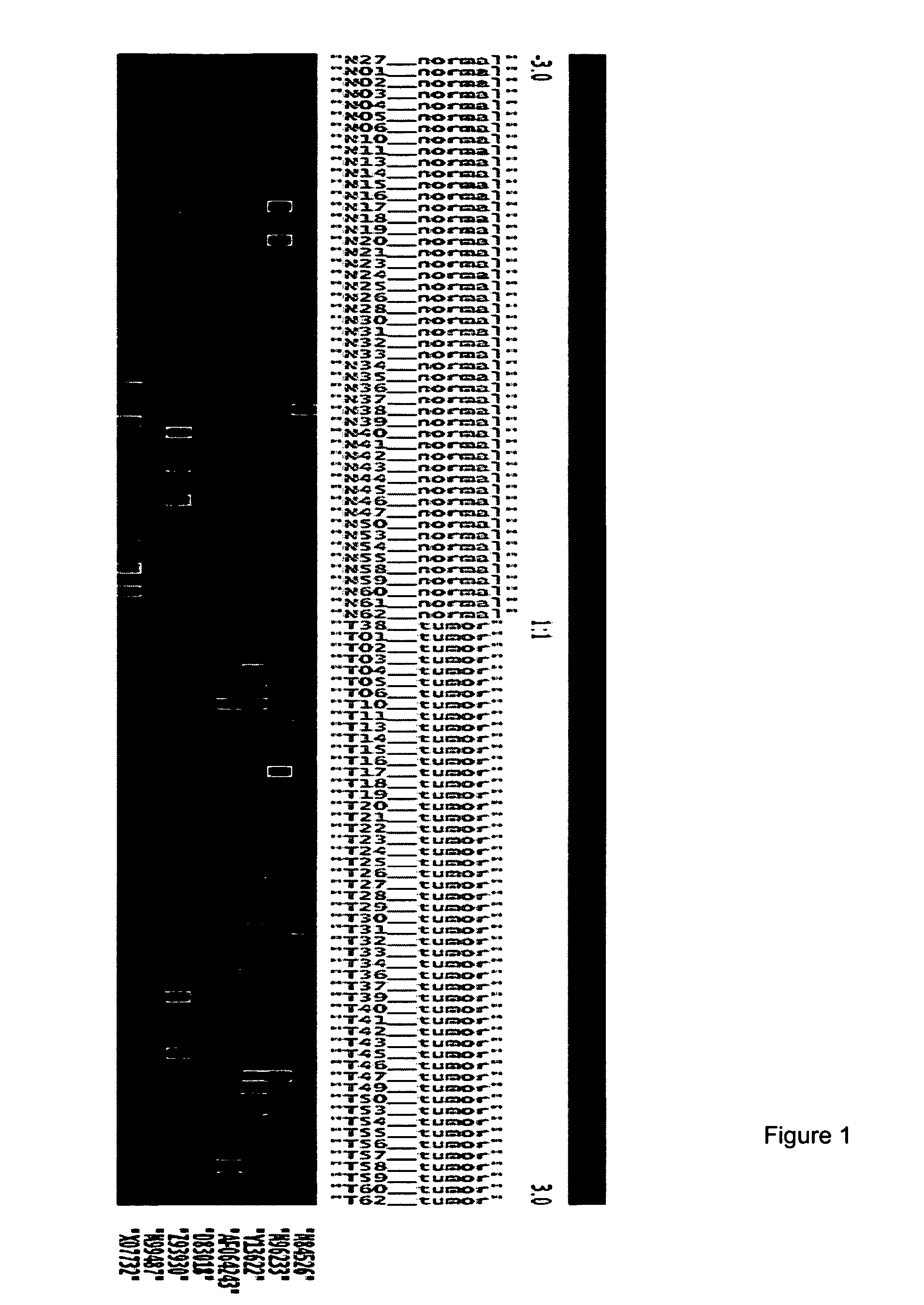 Molecular method for diagnosis of prostate cancer