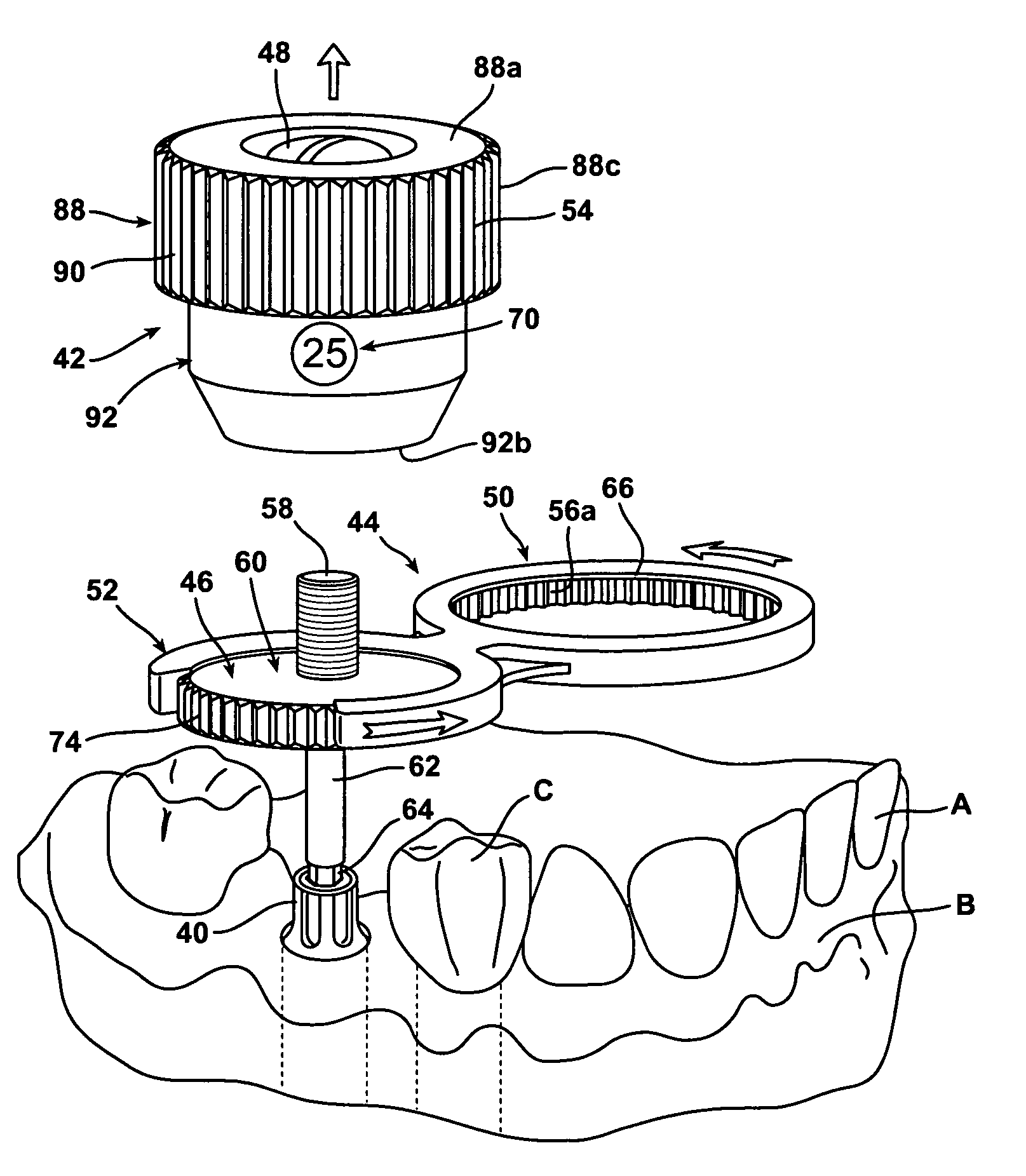 Torque wrench and kit for implant dentistry