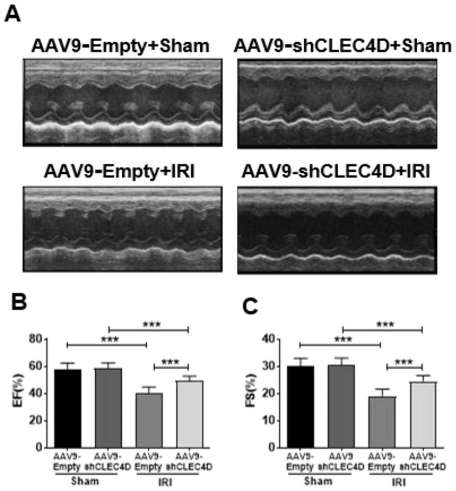 Application of reagent for knocking down or inhibiting CLEC4D in preparation of medicine for myocardial ischemia-reperfusion injury