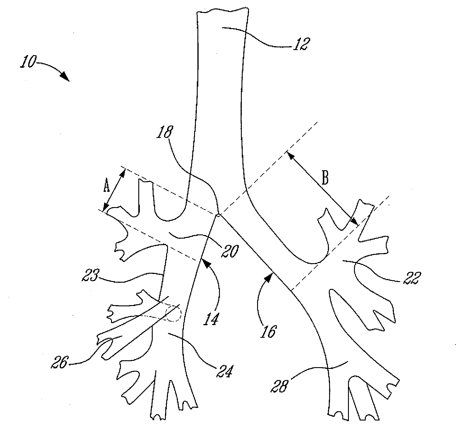 Right double lumen endobronchial tube