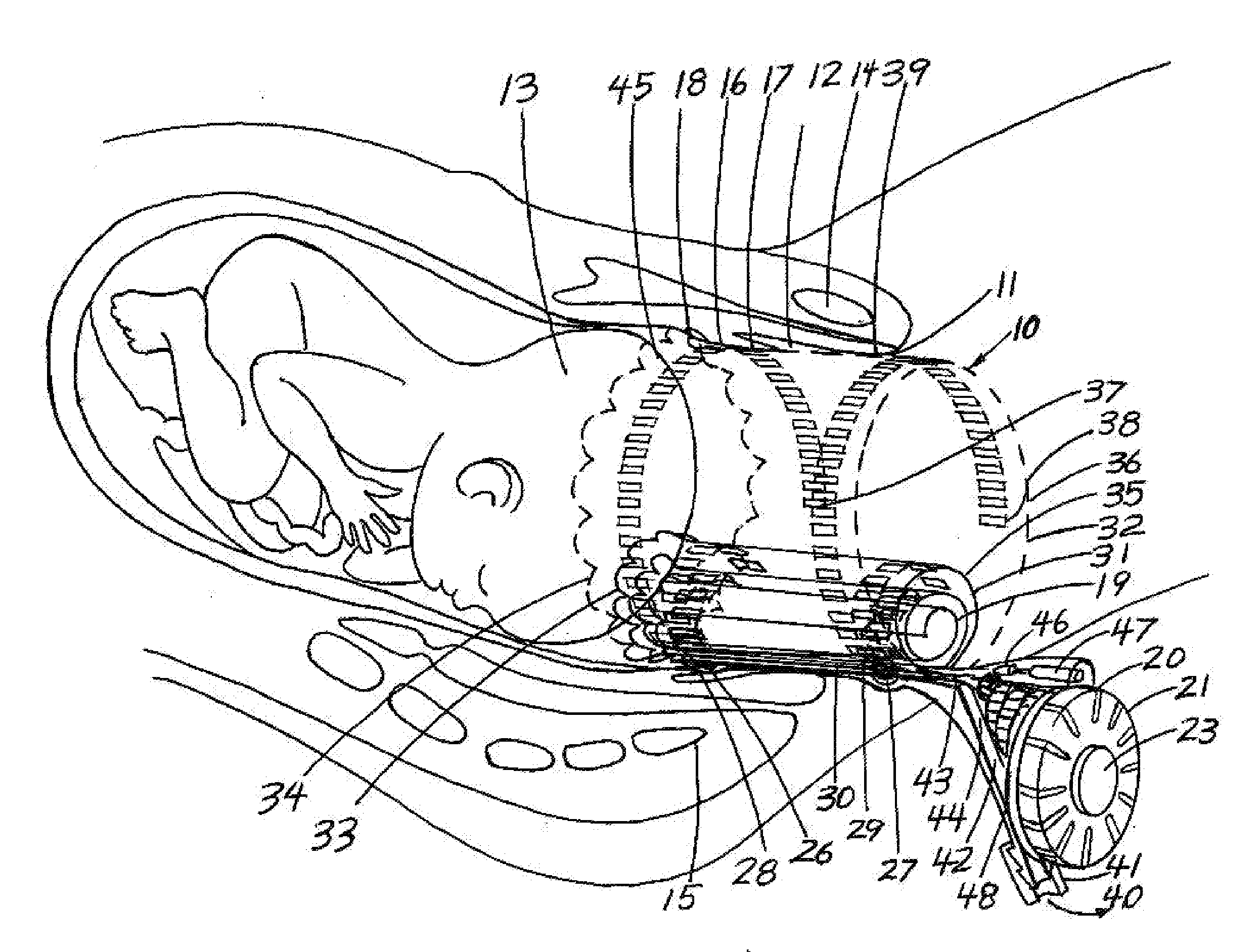 Childbirth labor reduction device