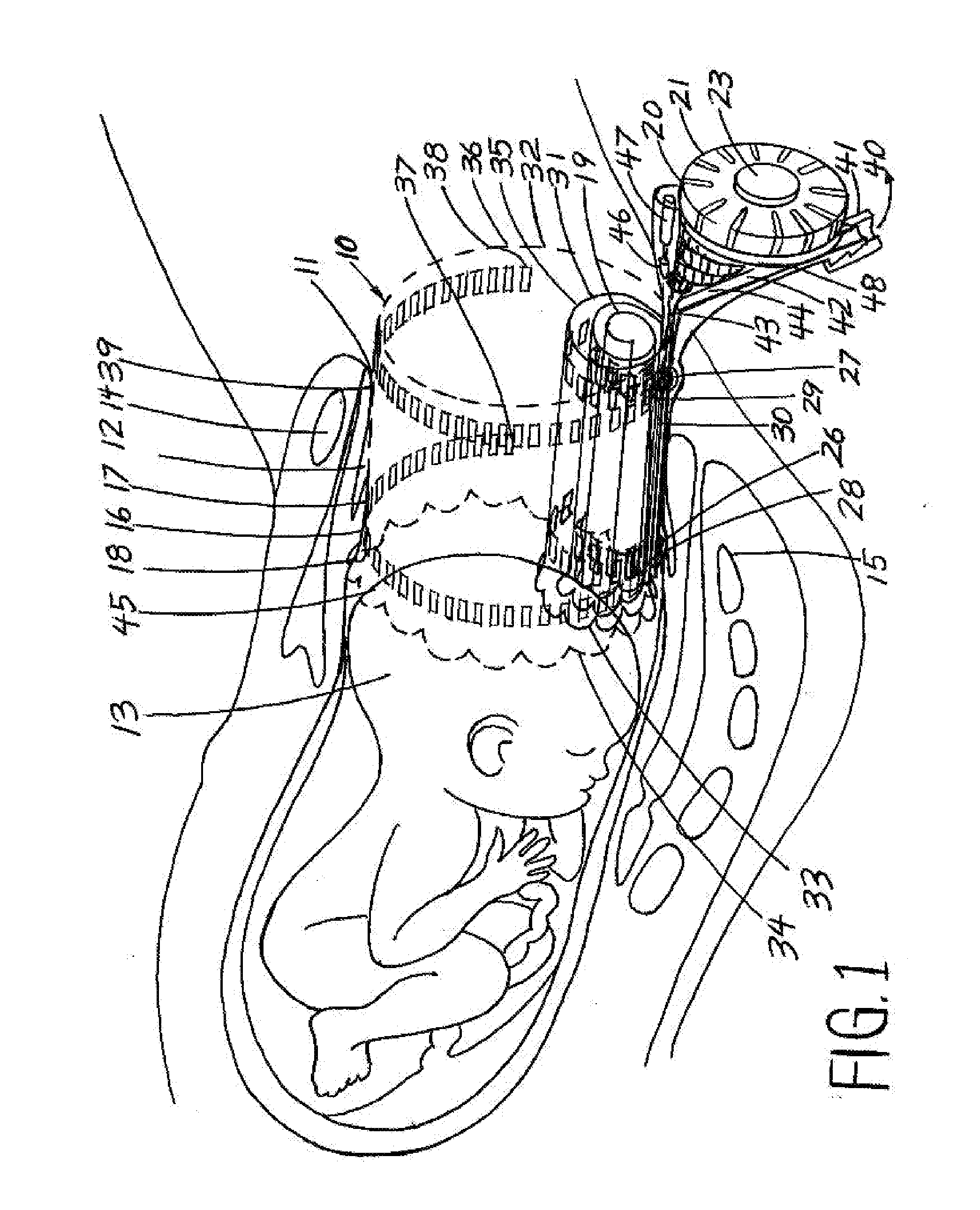 Childbirth labor reduction device